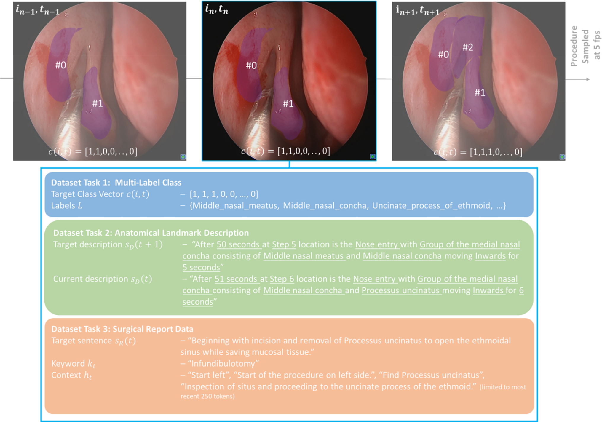 Using deep vision-language models improves multi-task performance in assistance applications for endoscopic ENT surgery