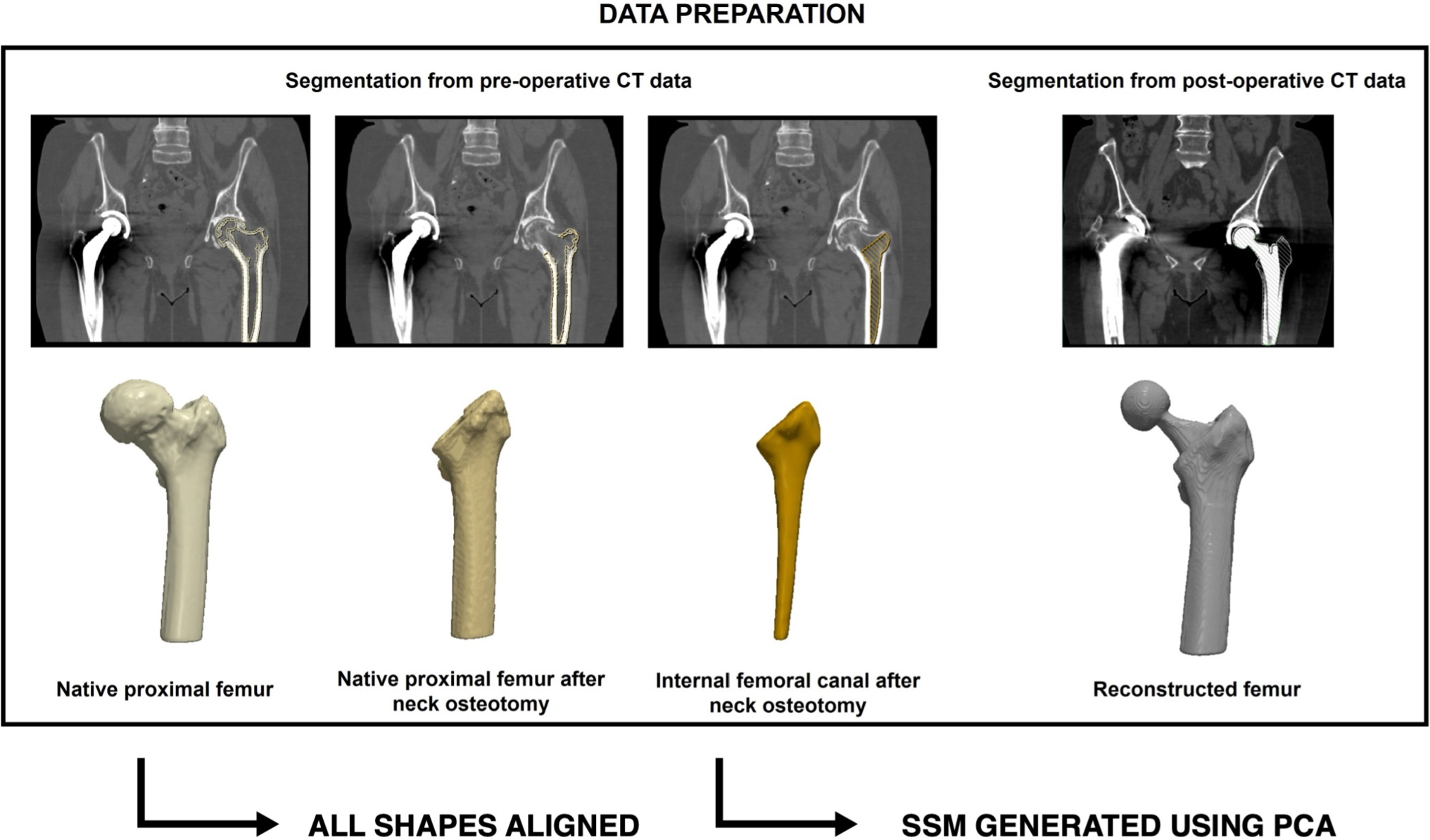 Quantifying the anatomical variability of the proximal femur