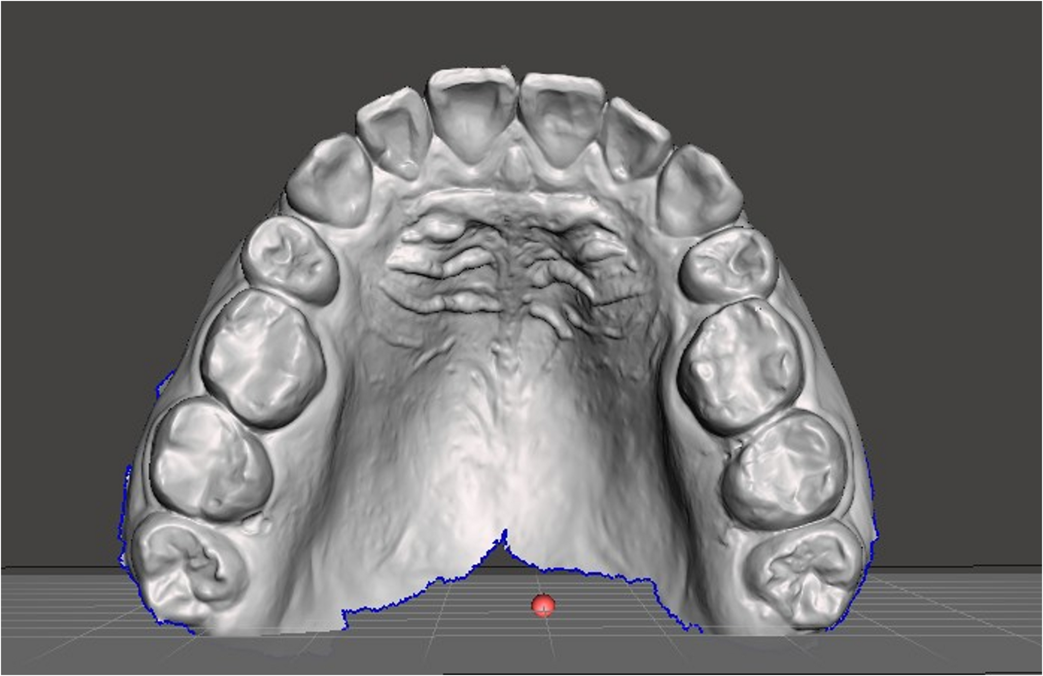 Distinguishing actual from 3D-rinted bite marks in forensic odontology: accuracy and reliability of digital analysis