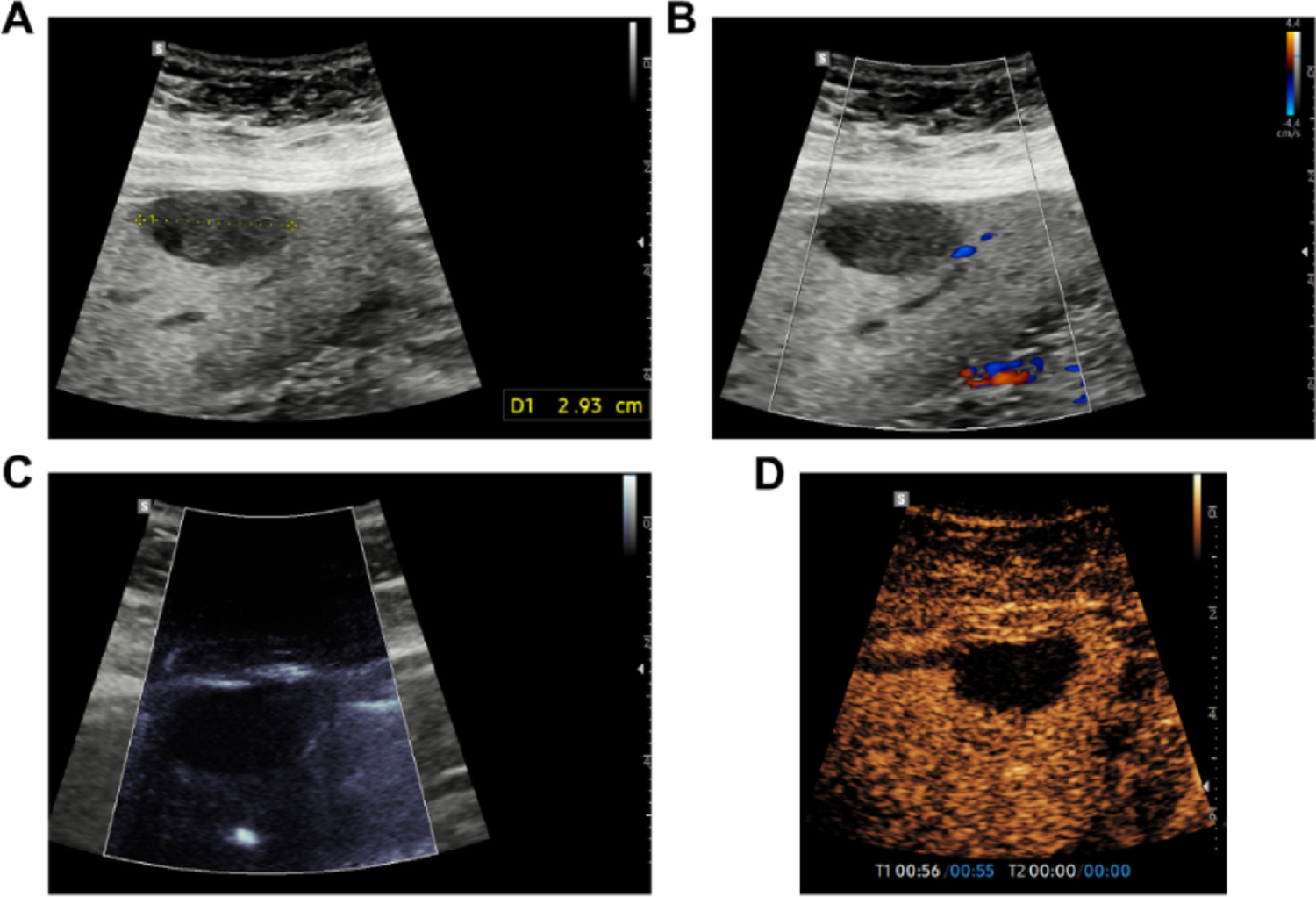 The “snow globe” sign: a microvascular flow imaging artifact in cystic lesions, and the role of dispersed internal debris