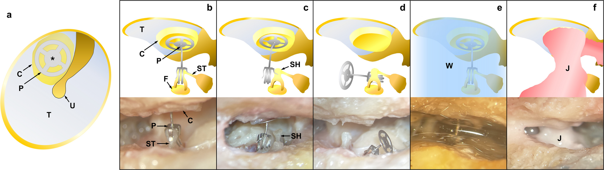 Differentiating Causes of Post-Surgical Conductive Hearing Loss with Optical Coherence Tomography Vibrometry