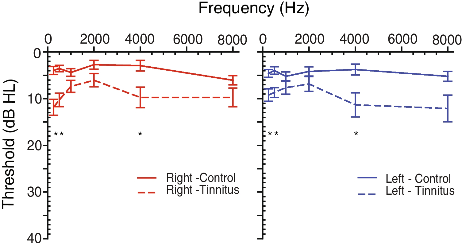 Enhanced 40 and 80 Hz Auditory Steady State Responses in Patients with Idiopathic Tinnitus