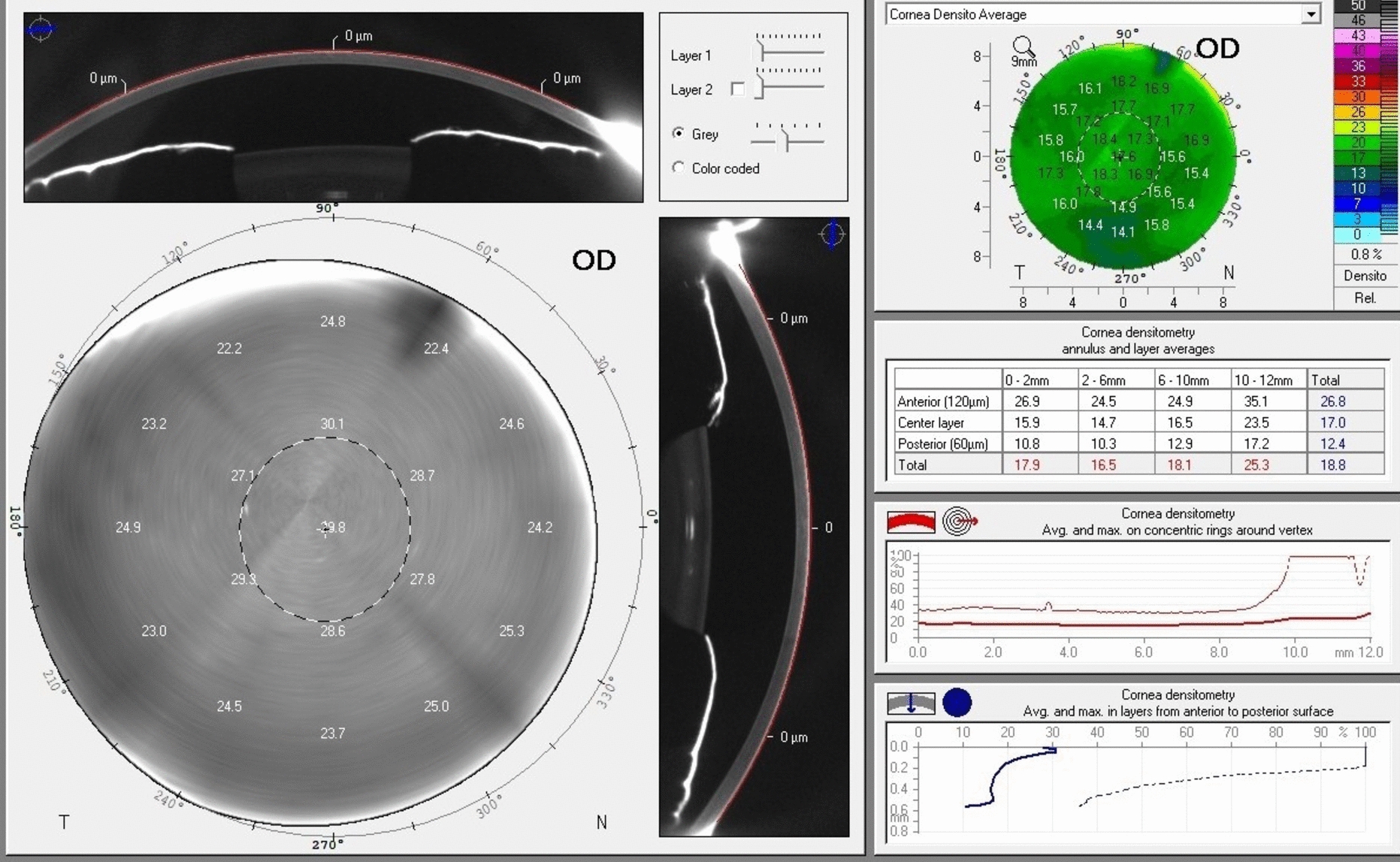 Changes in corneal and lenticular transparency in active and inactive Graves' Ophthalmopathy: a comparative densitometric study