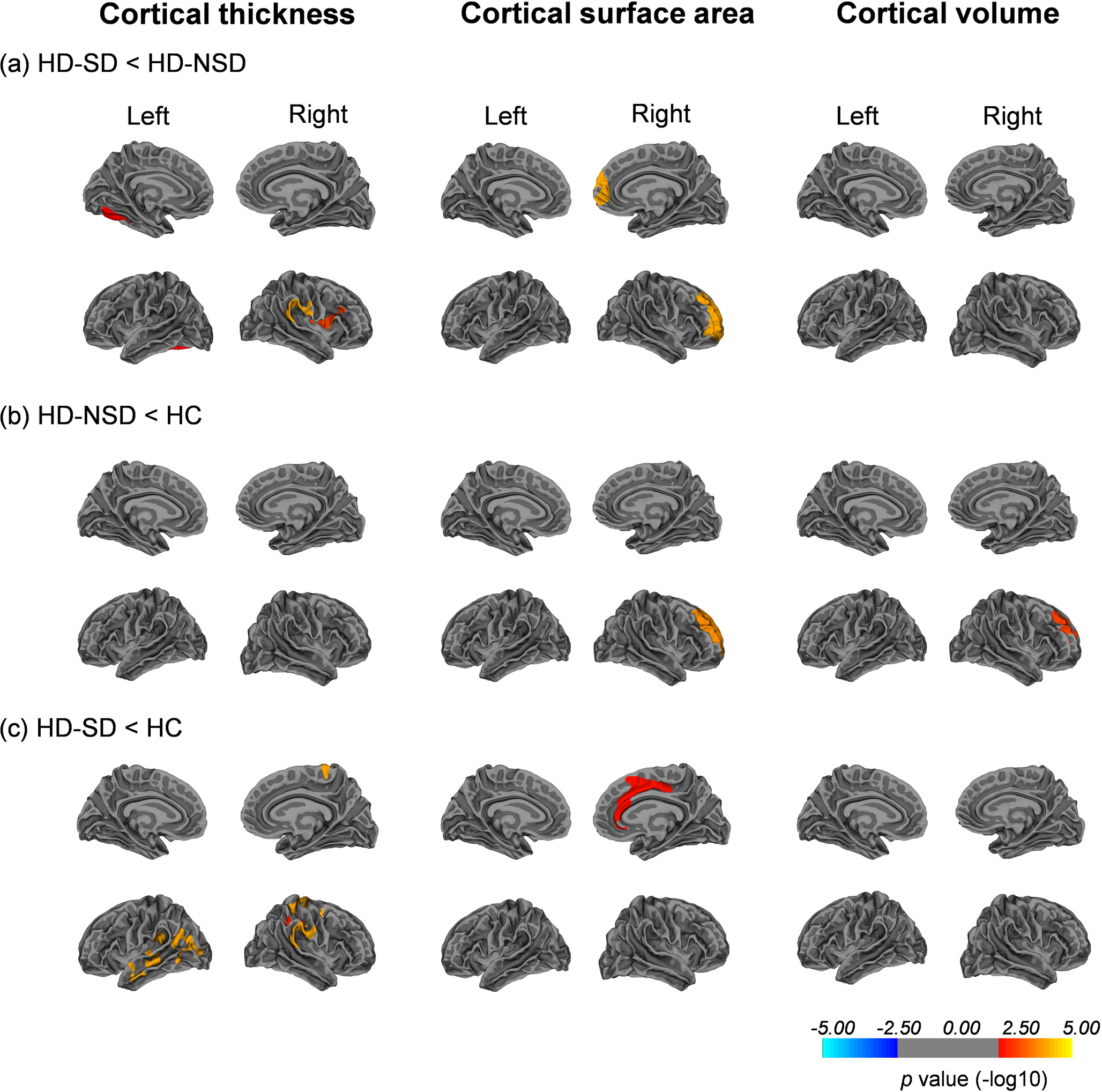 Cortical and subcortical gray matter alterations underlying sleep disturbances in patients with end-stage renal disease undergoing hemodialysis
