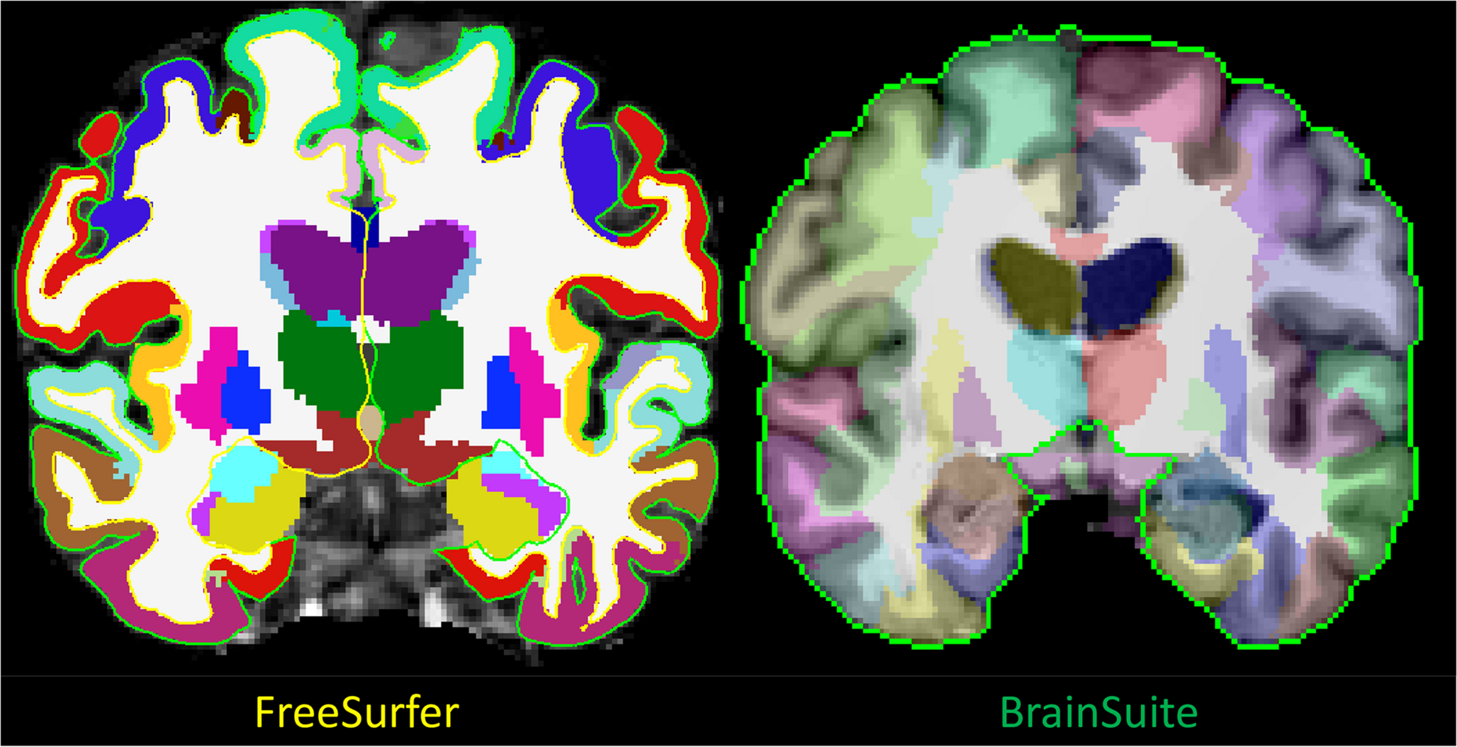 Comparative analysis of freesurfer and brainsuite in thickness, surface area, and volume measurements for morphometric group comparisons