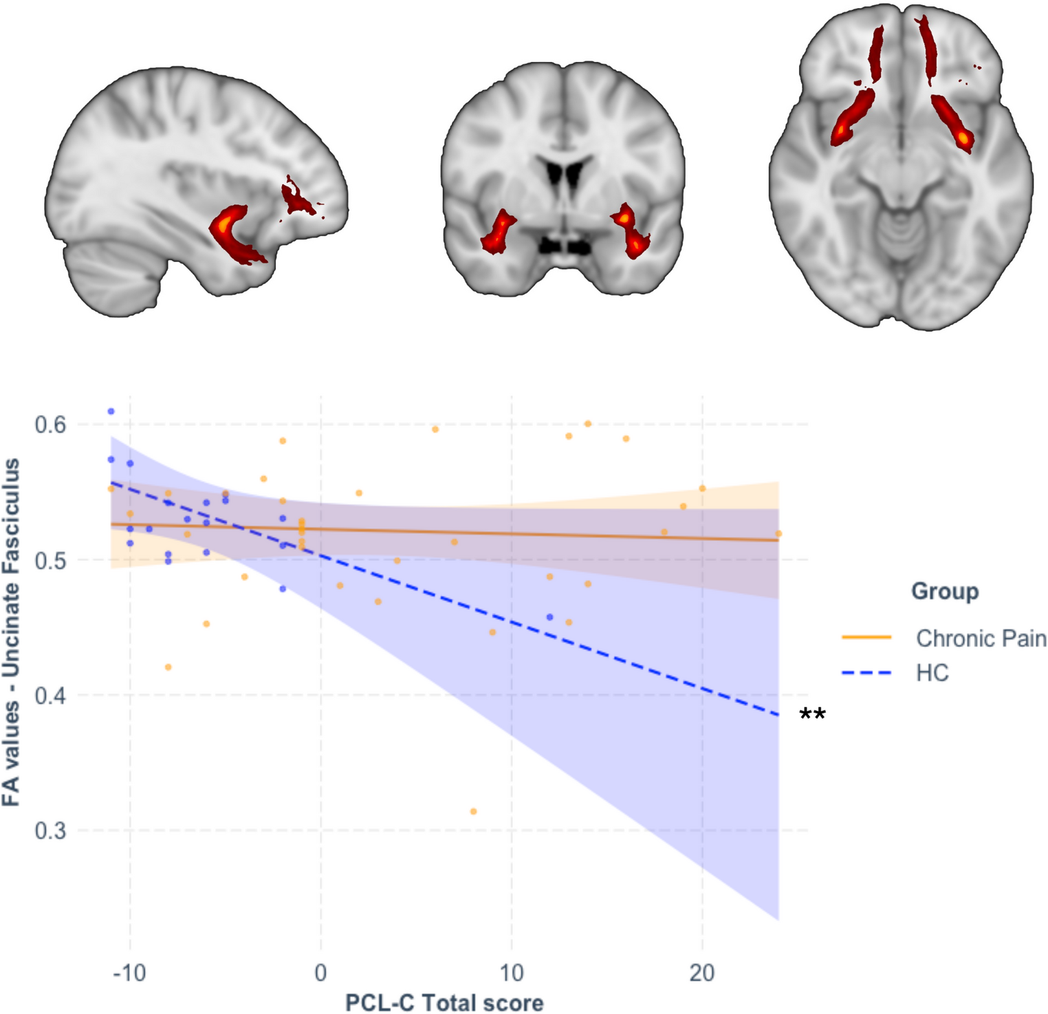 Stress-related white matter microstructure alterations and chronic pain