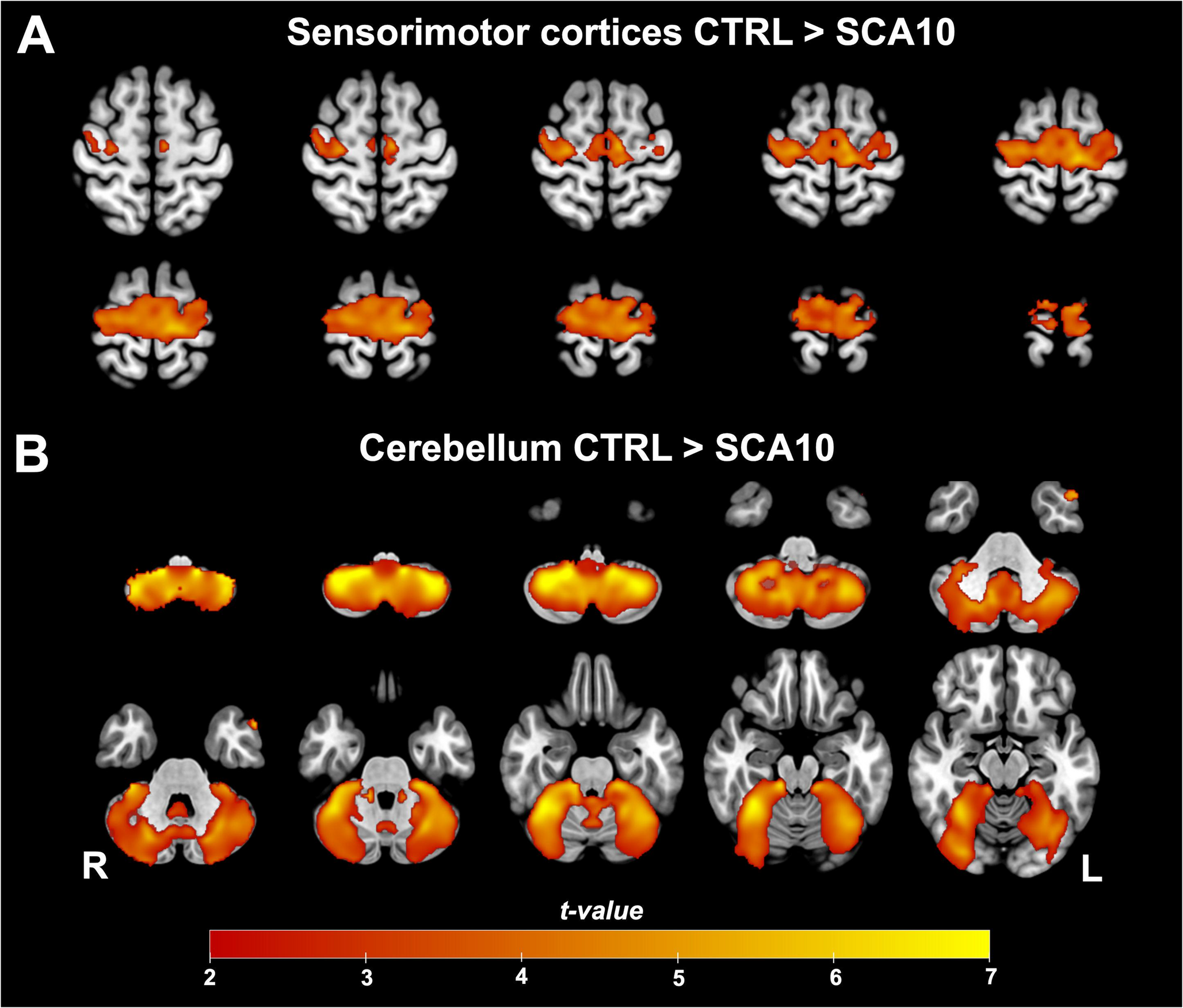 Functional connectivity alterations in spinocerebellar ataxia type 10: insights from gray matter atrophy