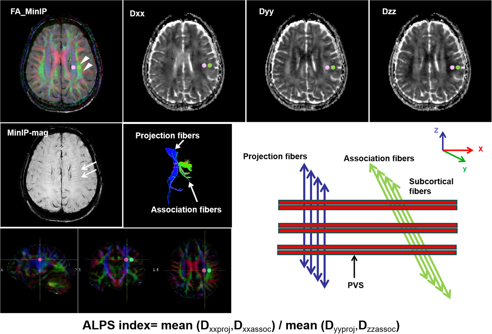 Associations among MRI-derived glymphatic system impairment, gray matter reserve and white matter integrity in cerebral small-vessel disease patients