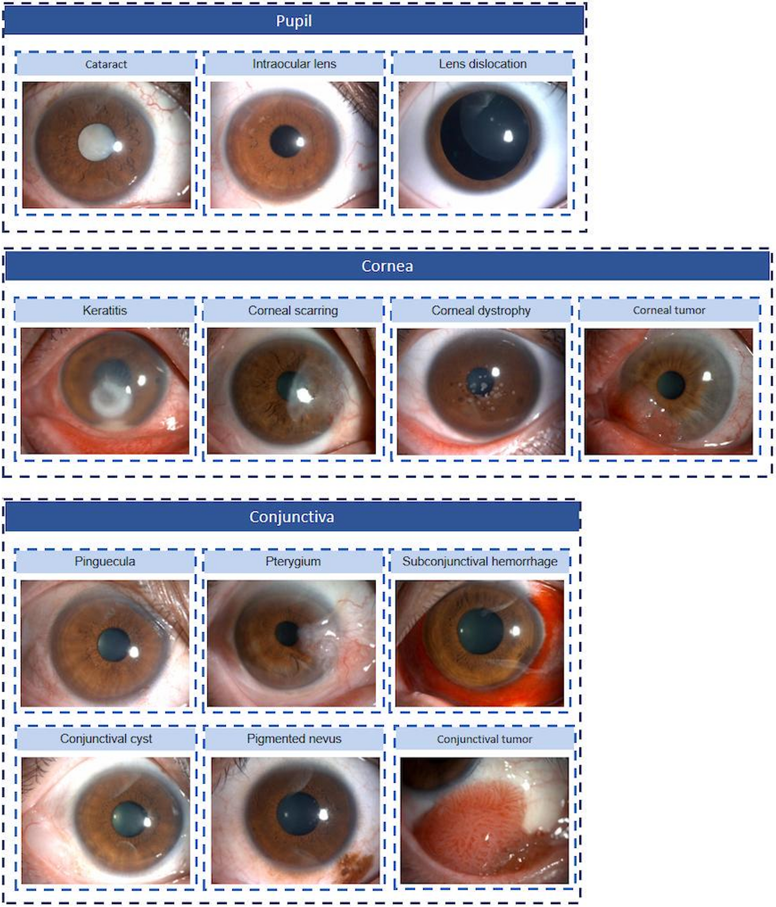 Validated semi-supervised early and accurate screening for anterior segment diseases: a 3PM-guided conceptual and technological innovation