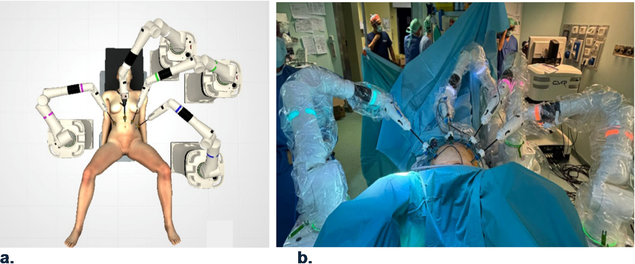 Robotic setup for ventral mesh rectopexy with the CMR versius platform: insights from clinical practice