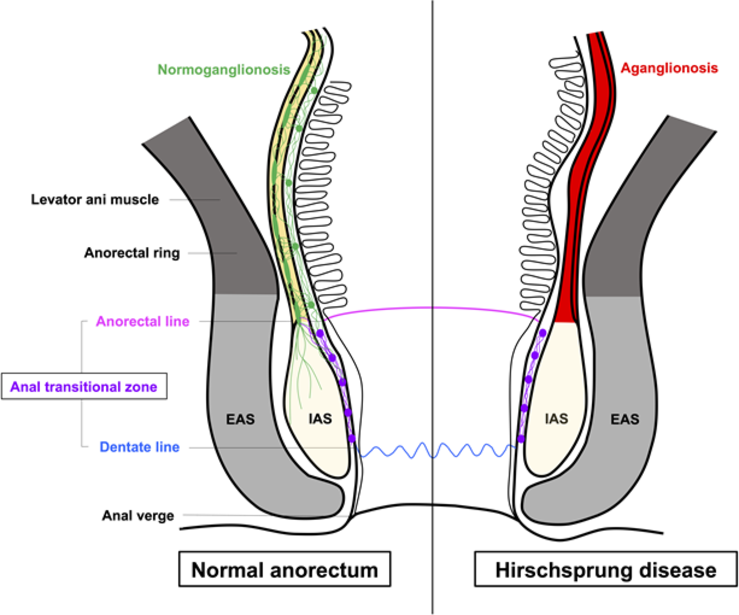 Historical aspects of anatomic landmarks during pull-through for hirschsprung disease: focusing on resection levels of the aganglionic rectum and rectal cuff issues