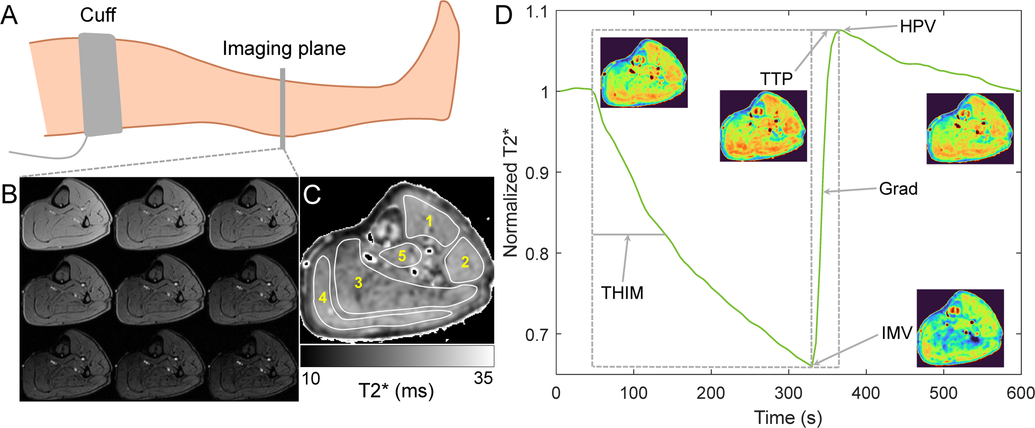 Blood oxygenation level-dependent MRI in critical limb-threatening ischemia: association with clinical and angiographic findings and response to revascularization