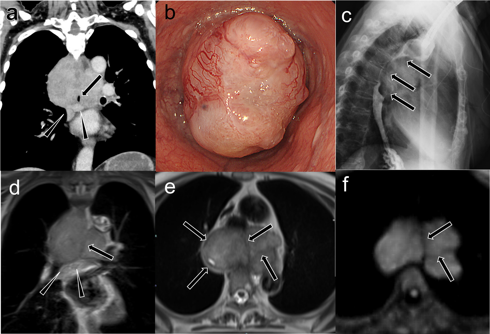 Esophageal schwannoma: MRI–pathology correlation with lymphoid cuffing