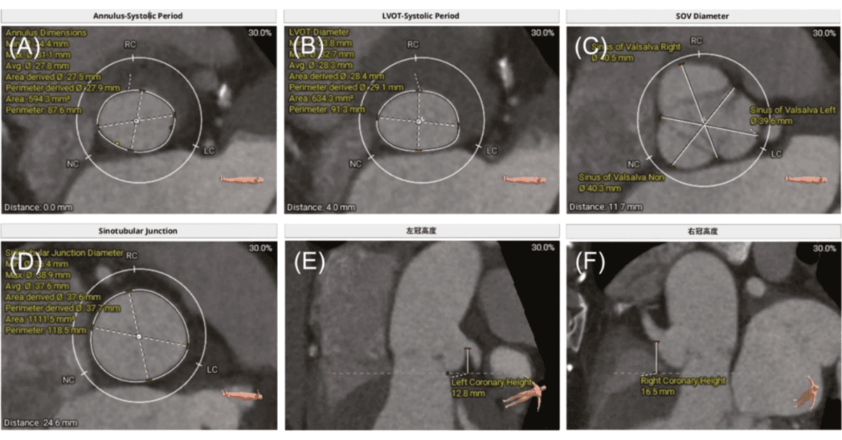 The Second Valve Drag and Reposition Technique for Rescue of Self-Expanding Aortic Valve Migration into the Left Ventricle during Transcatheter Aortic Valve Replacement for Pure Aortic Regurgitation