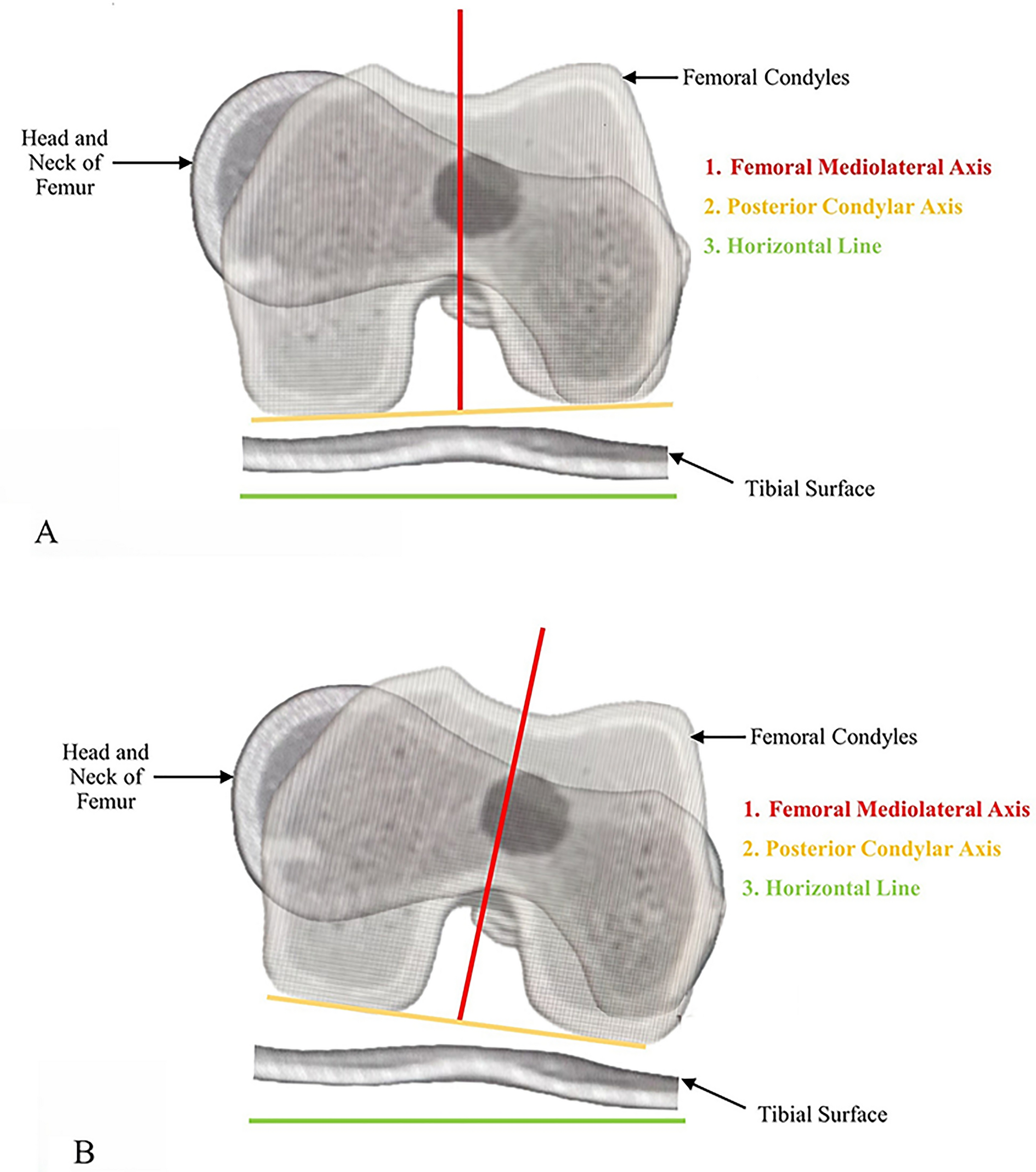 Role of relative intentional rotation of the femoral component in robotic-assisted primary total knee arthroplasty as a tool for the correction of medial flexion laxity