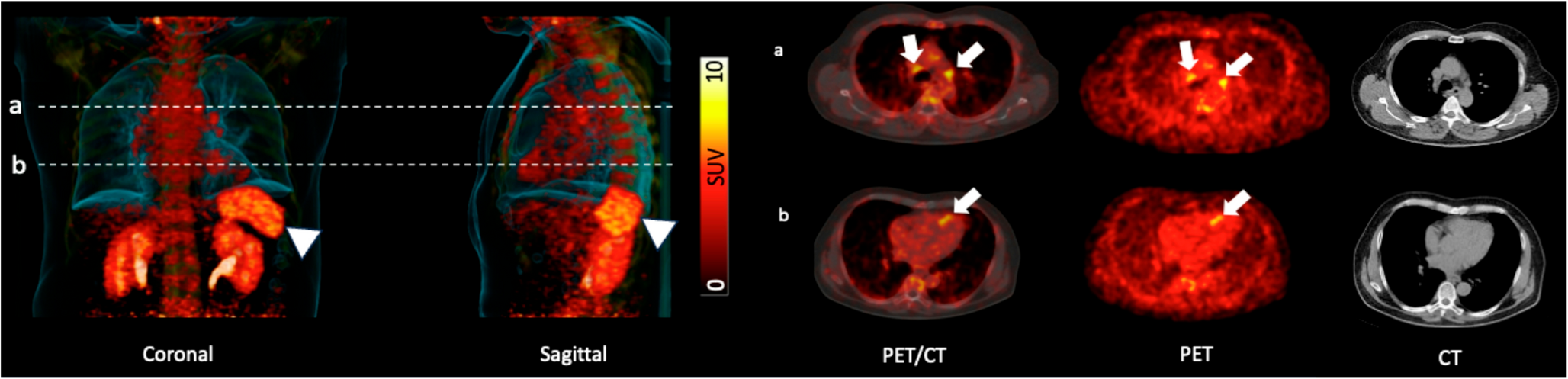 Molecular imaging of lymphatic organs provides prognostic value after acute myocardial infarction