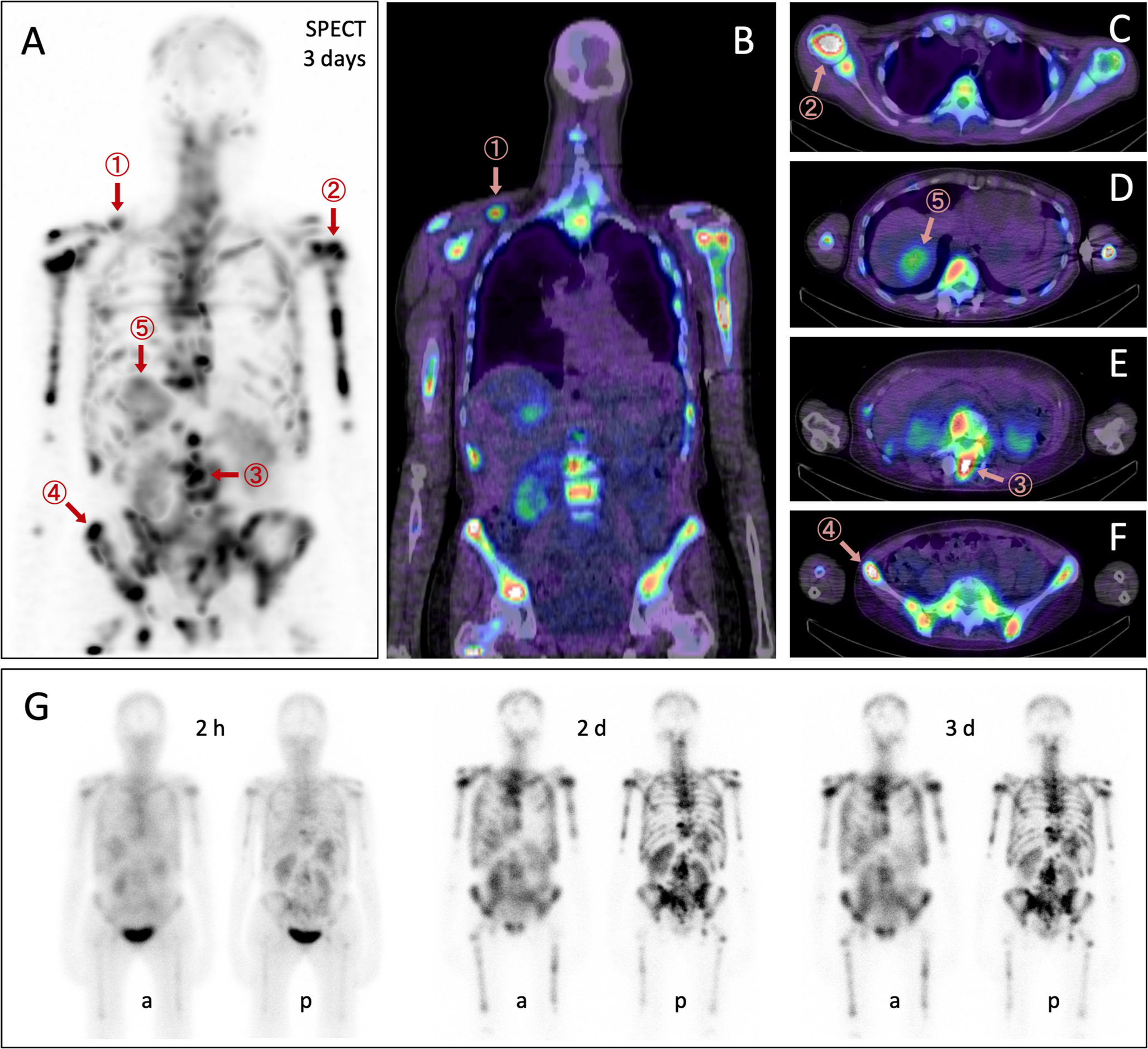 First αvβ6-integrin targeted radioligand therapy of breast cancer using Lu-177-Therahexin