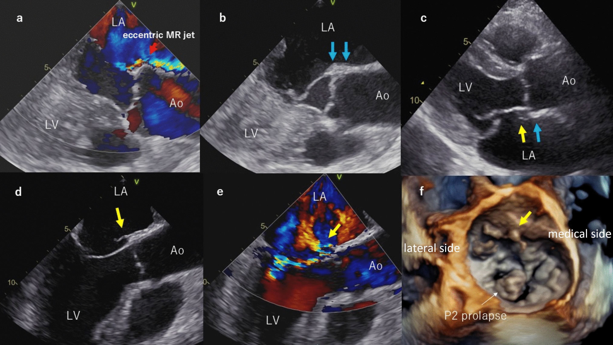 Progressive left atrial dissection caused by chronic eccentric mitral regurgitant jet