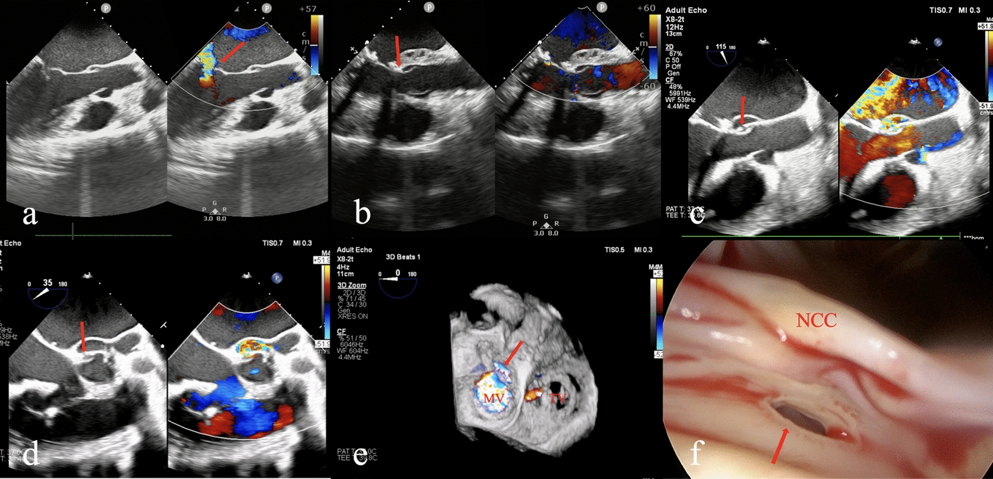 Sinus of Valsalva-left atrial fistula after mitral annuloplasty