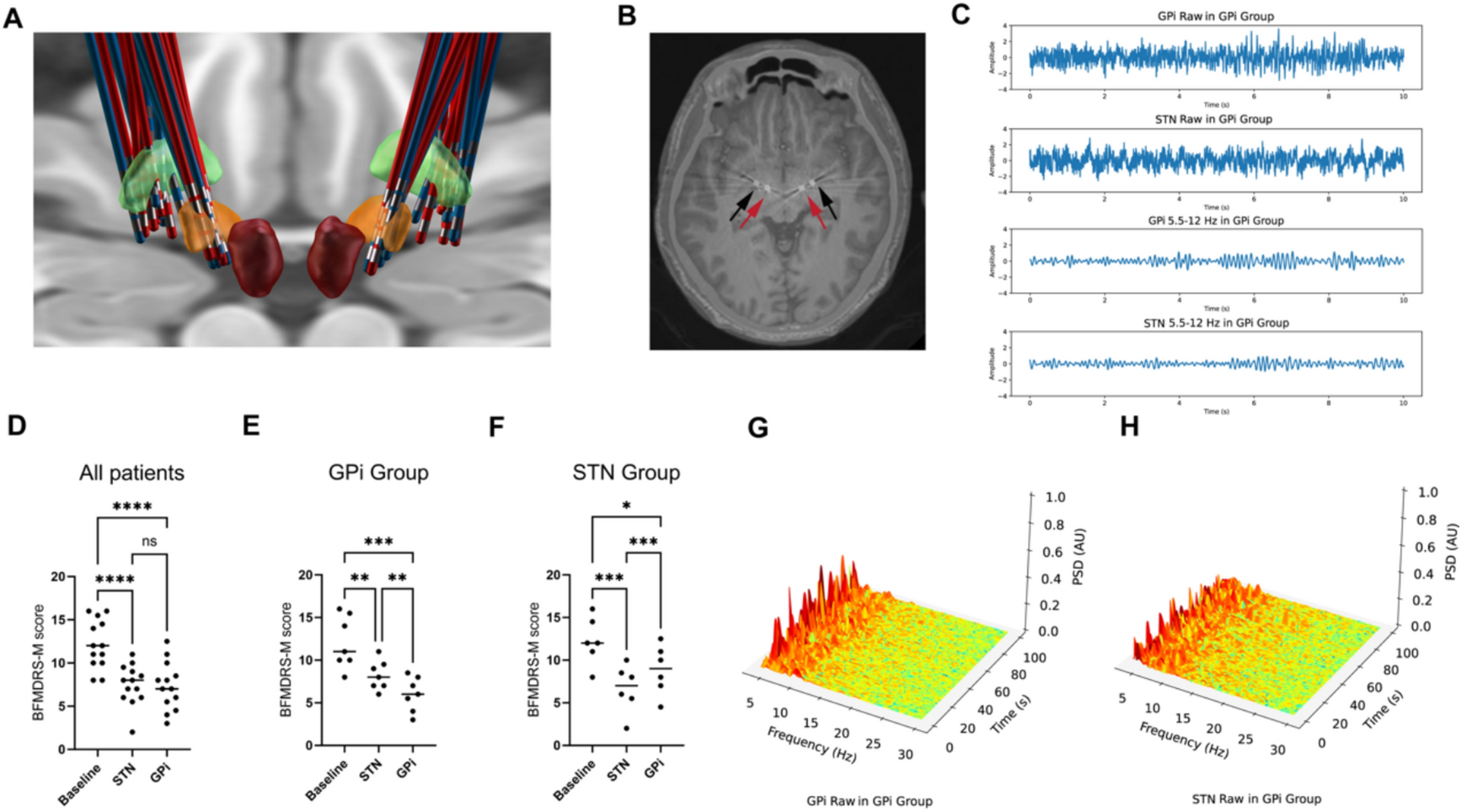 Association of low-frequency oscillations with target selection between the subthalamic nucleus and globus pallidus internus in blepharospasm–oromandibular dystonia