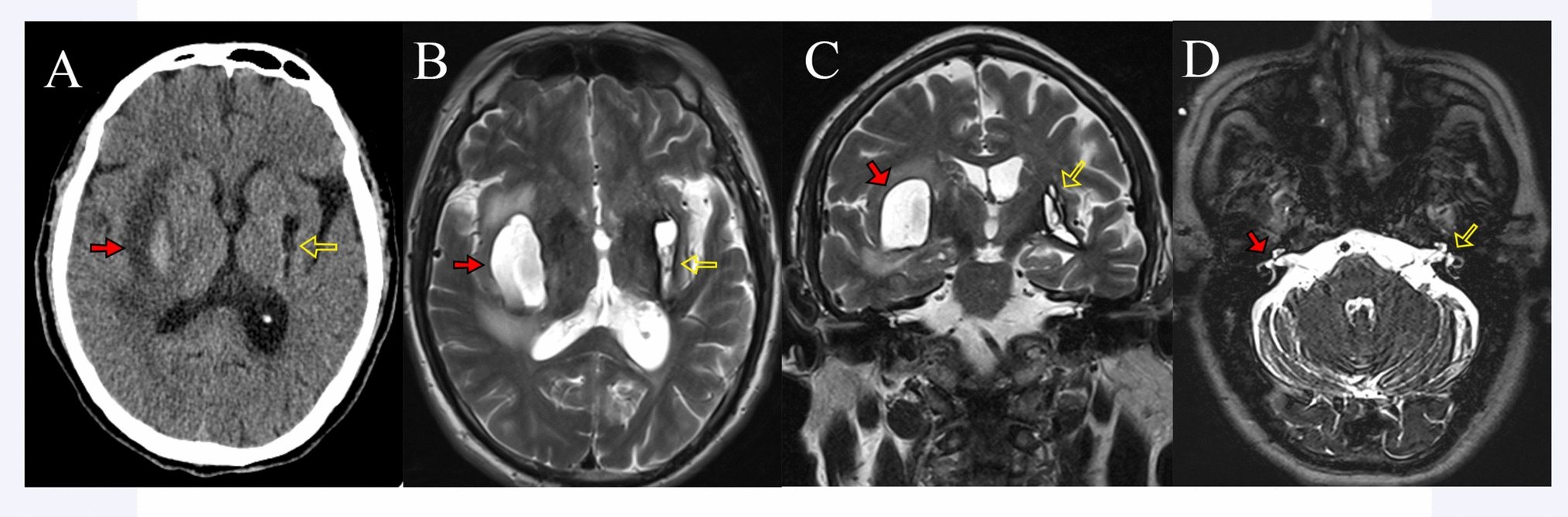 Sequential bilateral basal ganglia hemorrhage causing central bilateral deafness