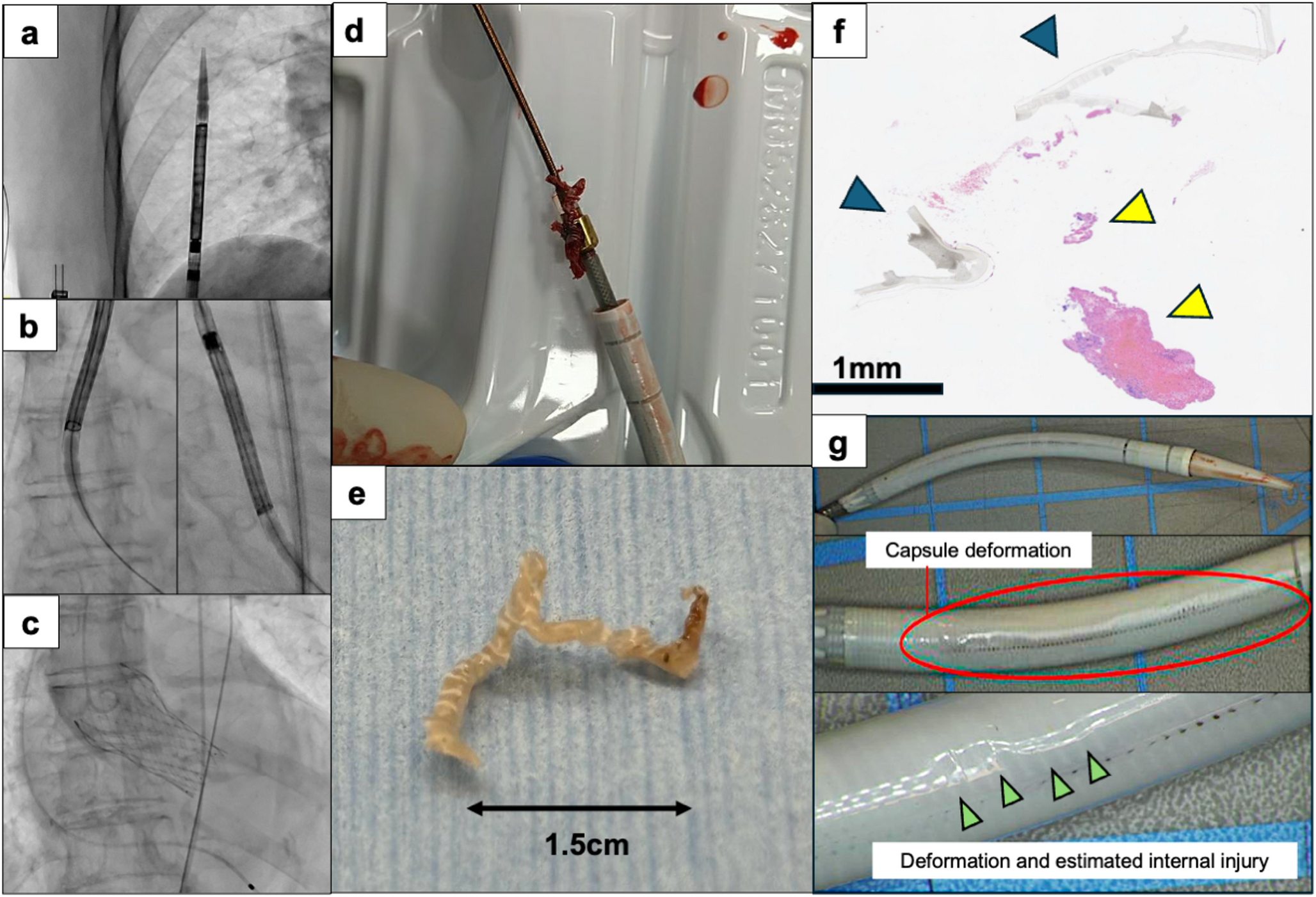Capsule deformation of a self‑expandable transcatheter aortic valve caused by repeated valve captures