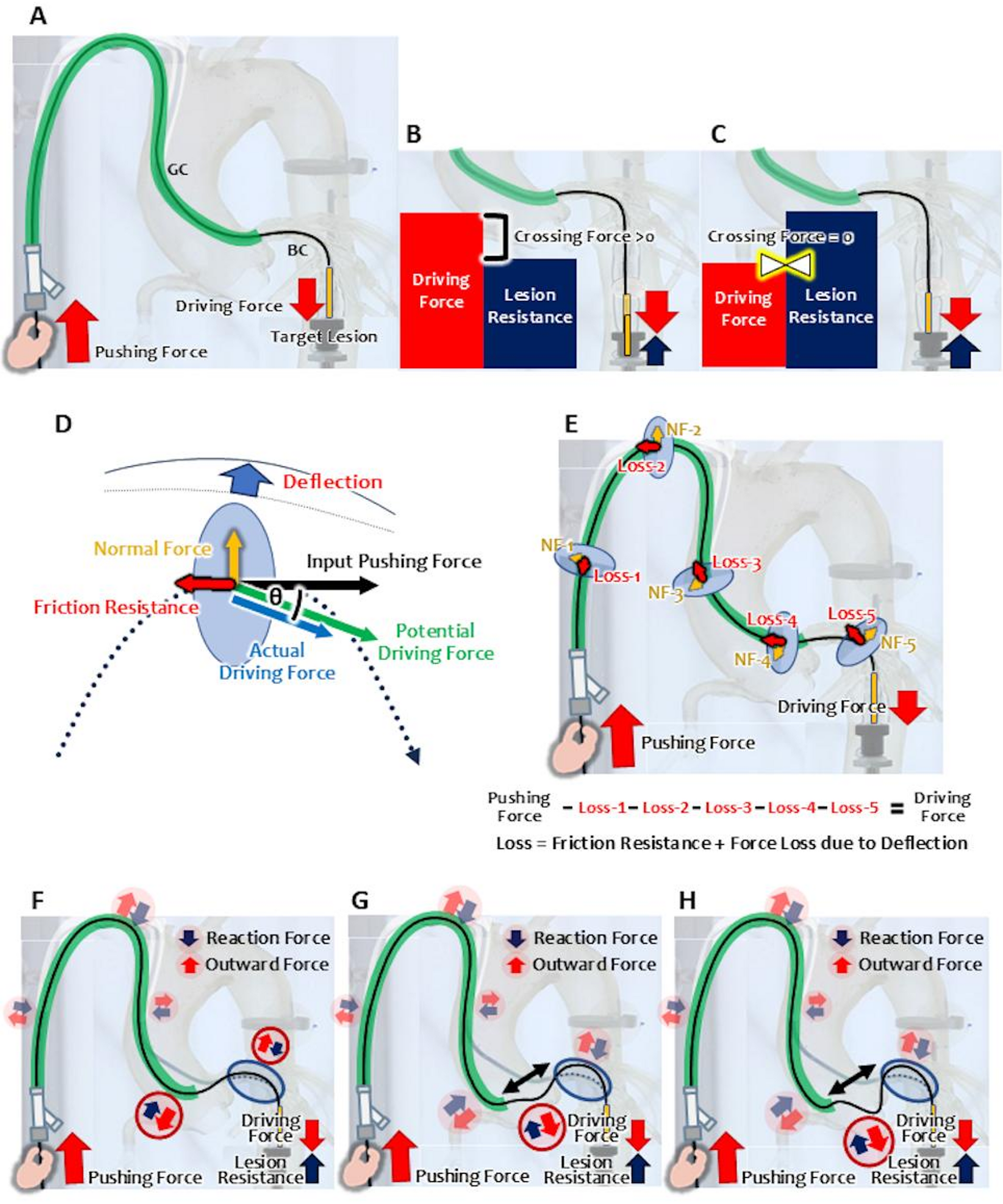A novel theoretical model and experimental validation of backup force in percutaneous coronary intervention