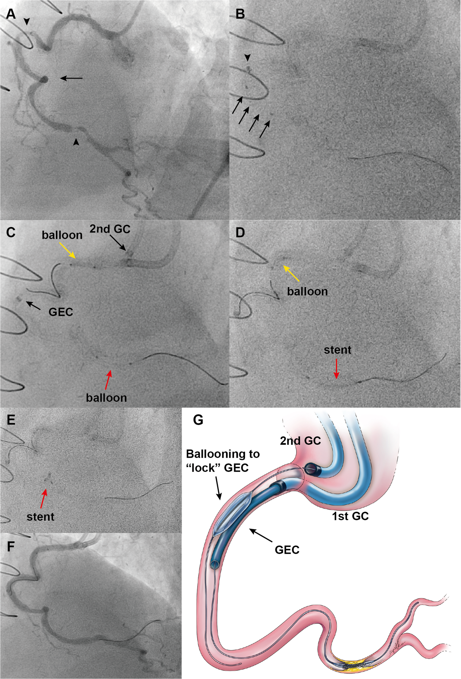 Modified guide-extension proximal locking method using dual guiding catheters (GP-Lock-DG) in percutaneous coronary intervention
