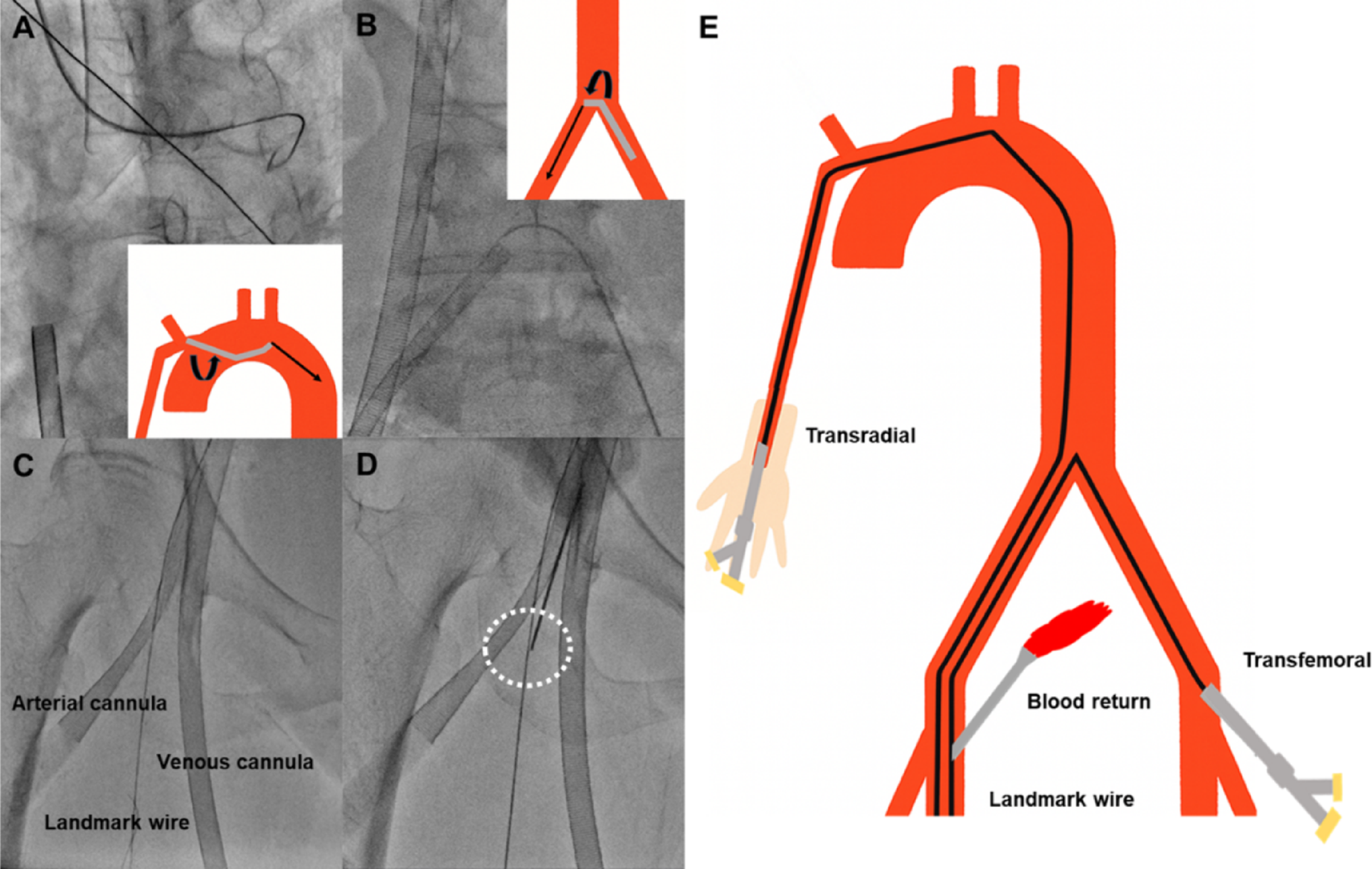 Wire-guided puncture technique for lower limb distal perfusion catheter insertion after mechanical circulatory support