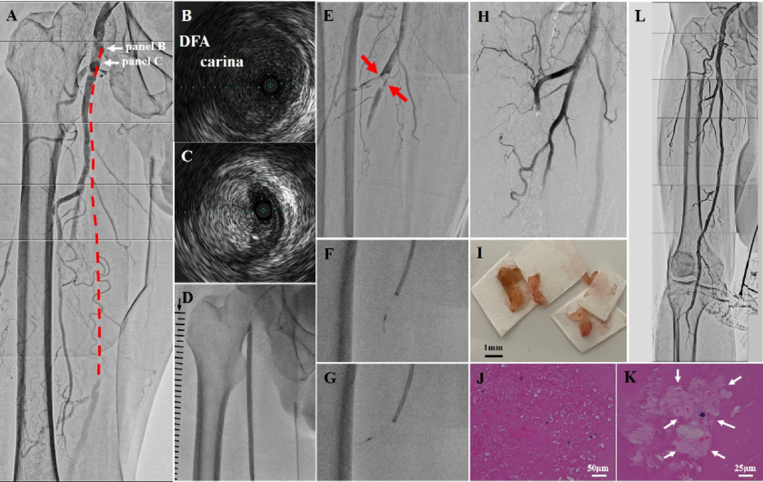 Distal embolism due to suspicious plaque shifting from superficial to deep femoral artery