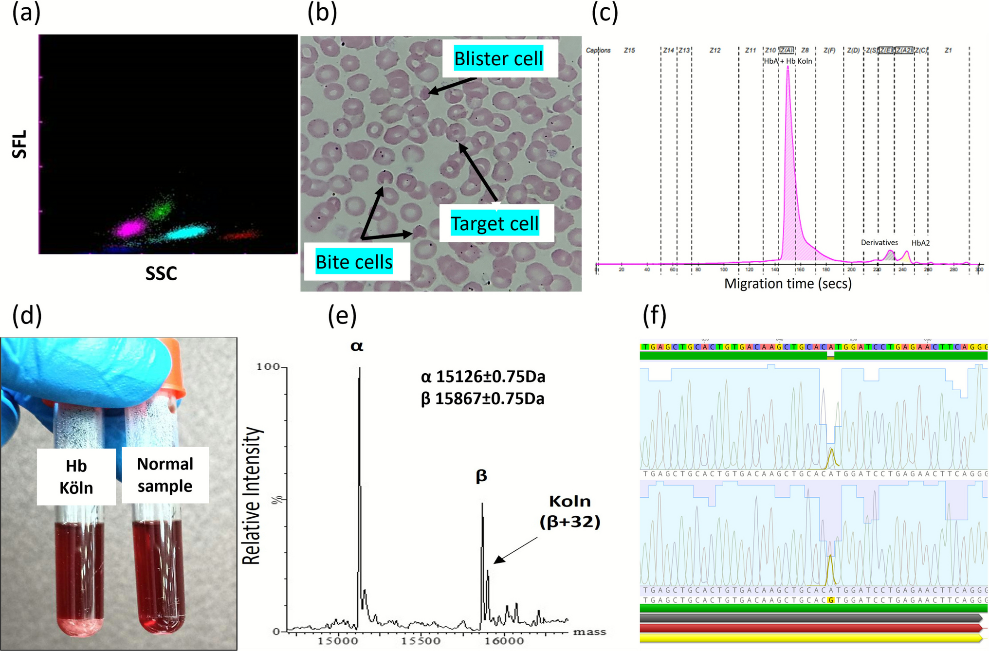 Rare variant hemoglobin Köln in Southern India—an underdiagnosed entity?