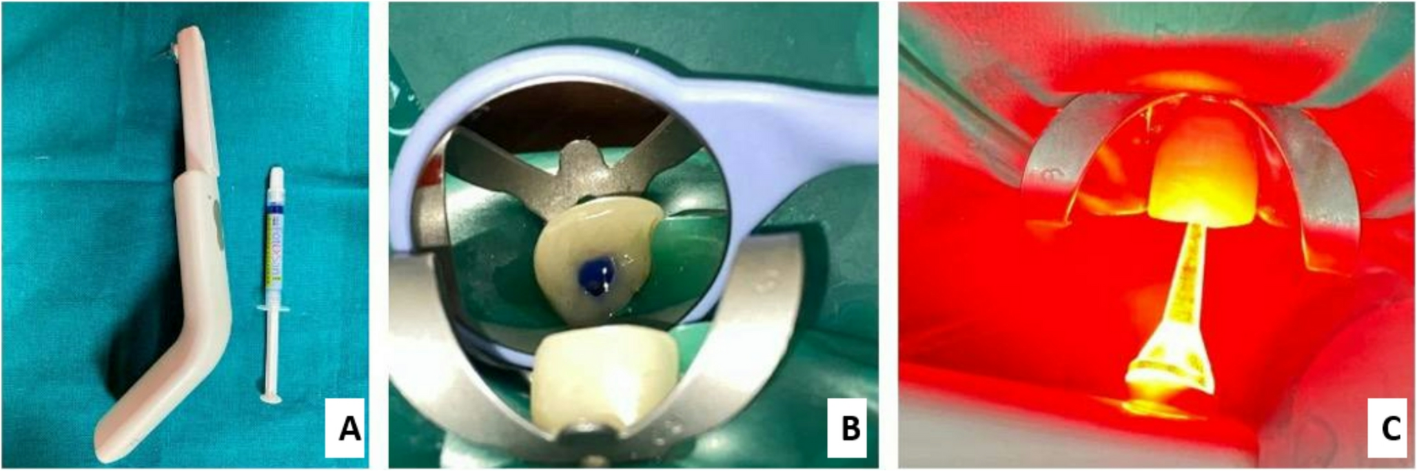 `Effect of adjunctive antimicrobial photodynamic therapy on periapical healing and IL-6 modulation in apical periodontitis: a pilot randomized controlled study