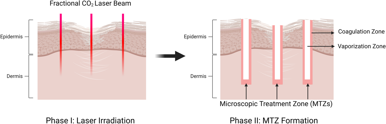 An Overview of the Mechanisms of Fractional CO Laser in Scar Treatment