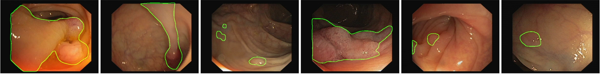 MLB-Net: A Multi-level Lesion-Aware and Boundary-Enhanced Network for Polyp Segmentation