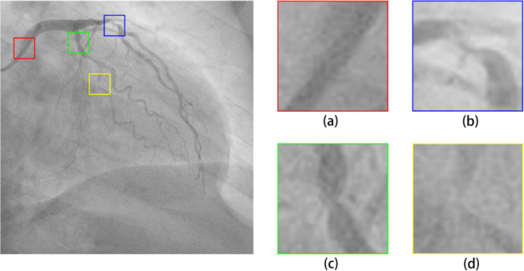 Stenosis-YOLO: Semisupervised YOLOv8 with Edge Enhancement and Hierarchical Feature Fusion for Coronary Stenosis Segmentation