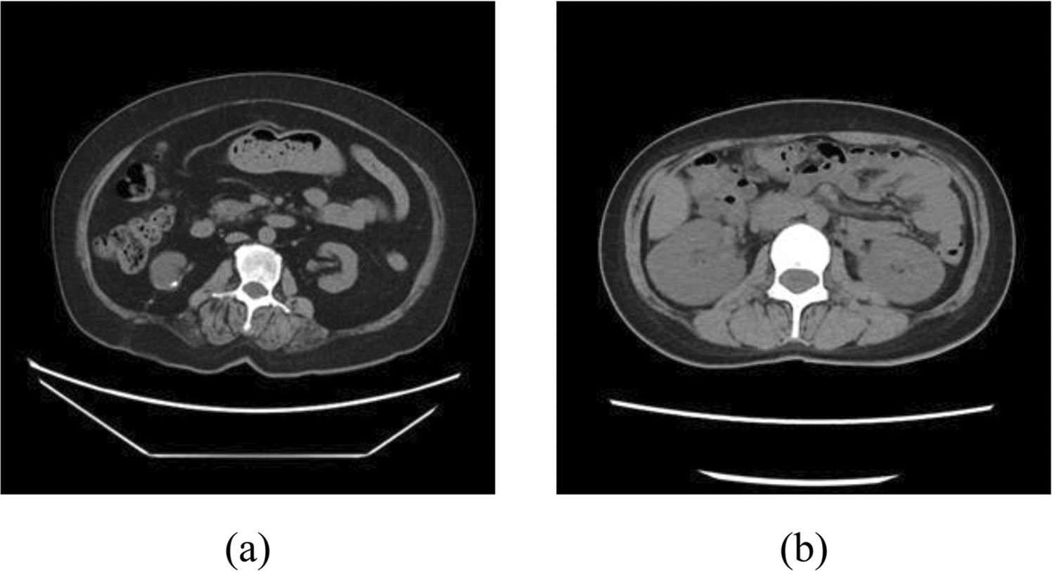LRF-UNet: Low-Rank Factorized Convolution Deep-Learning Networks for Visceral Adipose and Muscle Tissue Segmentation in Abdominal Computed Tomography Image