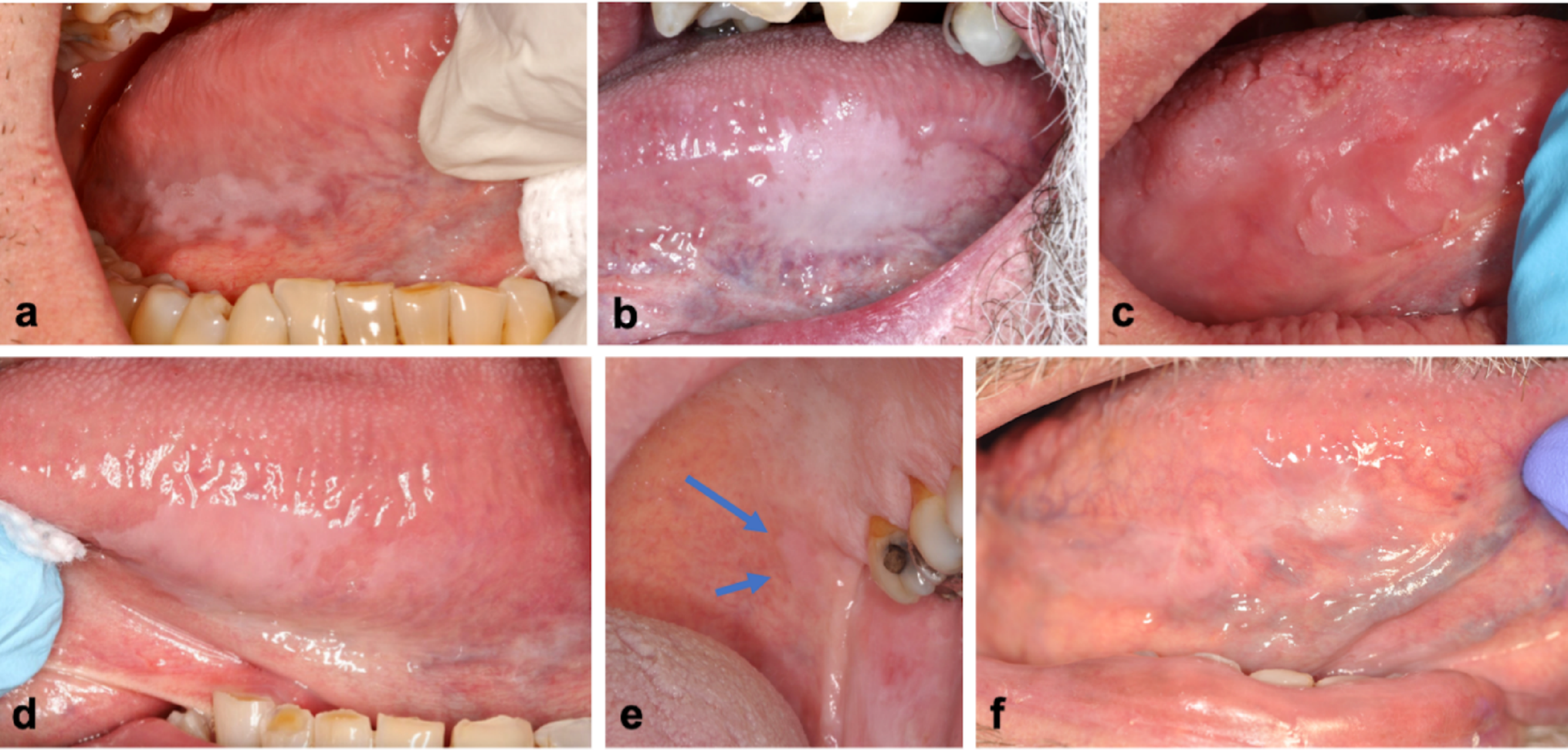 Oral Glycogenic Acanthosis: A Clinicopathological Analysis of 13 Cases and Narrative Literature Review