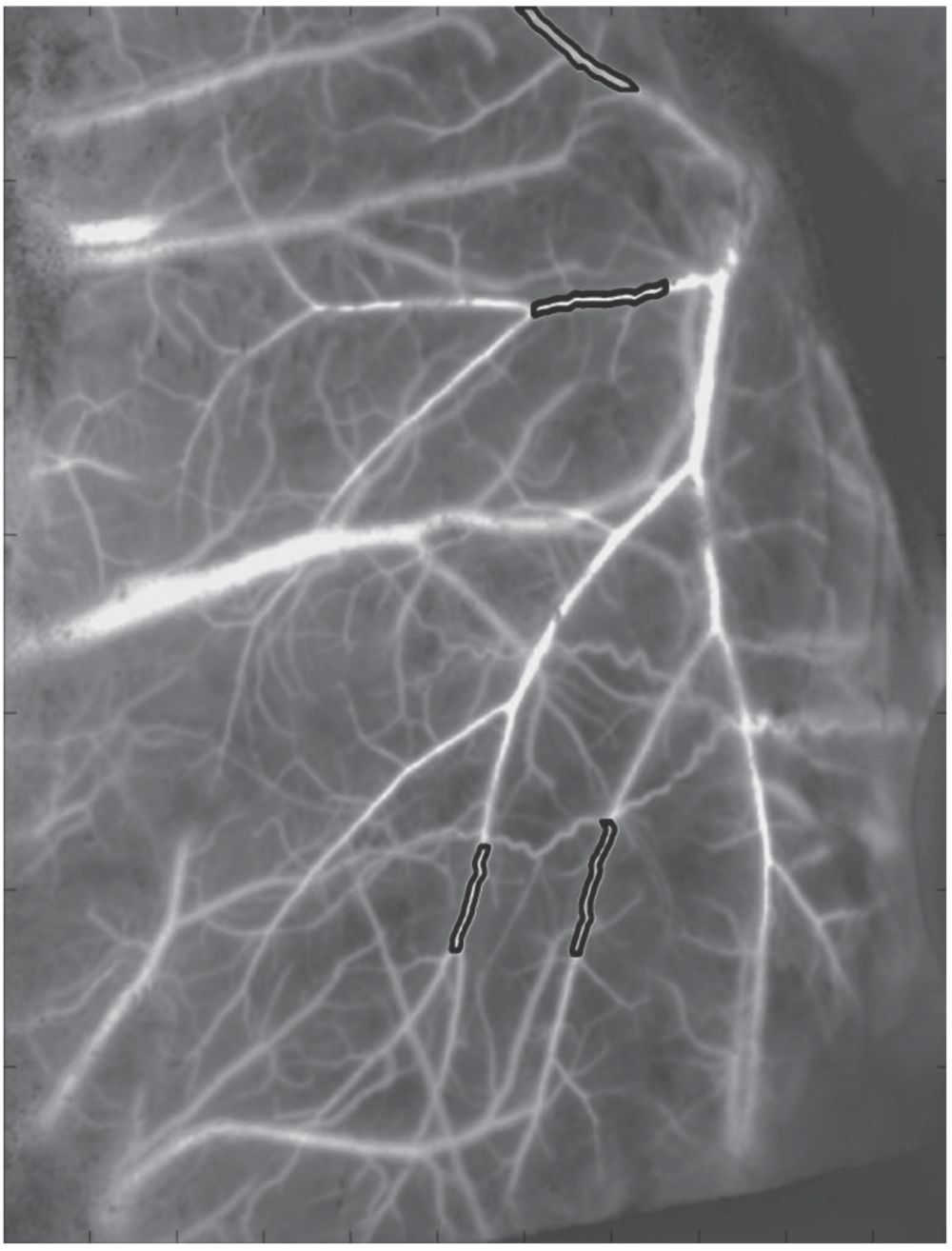Disruption of Blood Flow Autoregulation in the Middle Cerebral Artery Bed in Rats with Carotid Artery Stenosis