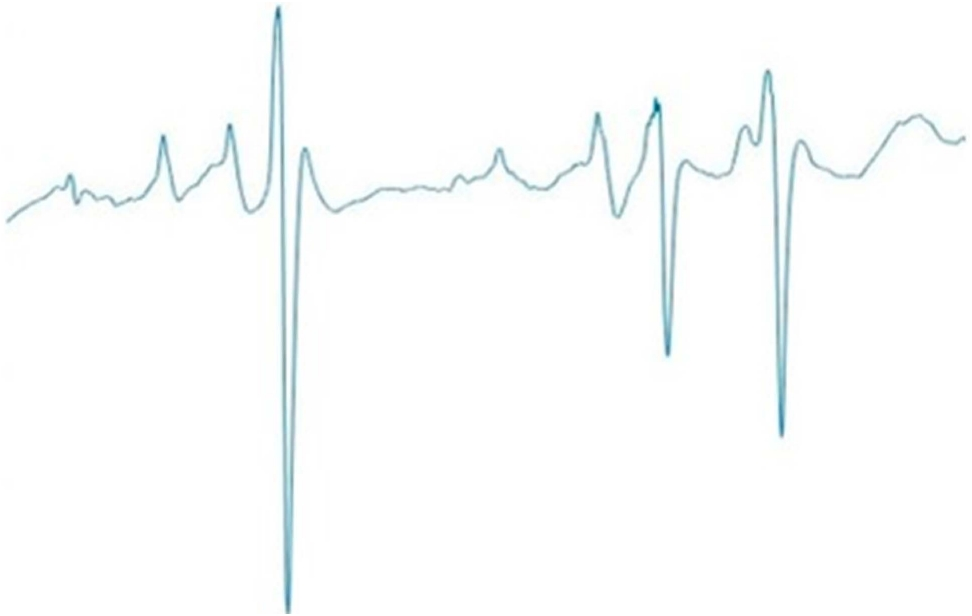 WaveNet’s Precision in iEEG Classification