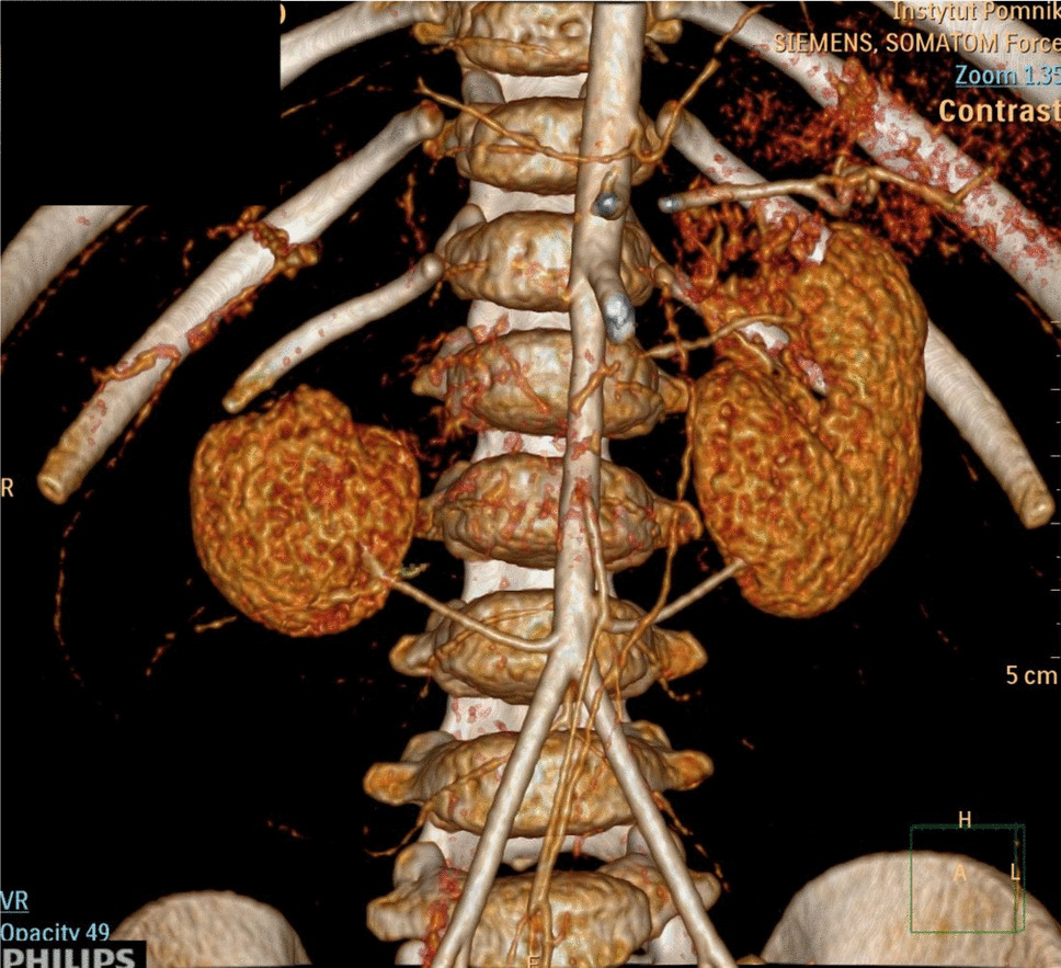 Severe renovascular hypertension in an infant with a  gene variant