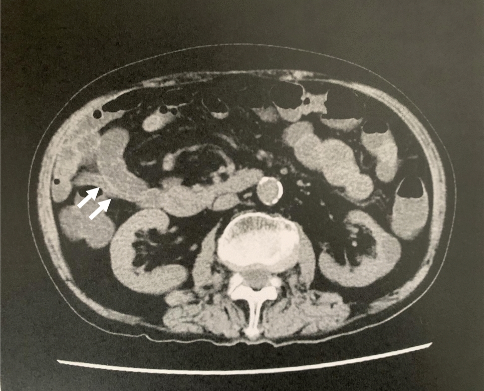 Olmesartan-associated enteropathy presenting with metabolic acidosis and acute kidney injury requiring hemodialysis: a rechallenge-confirmed case