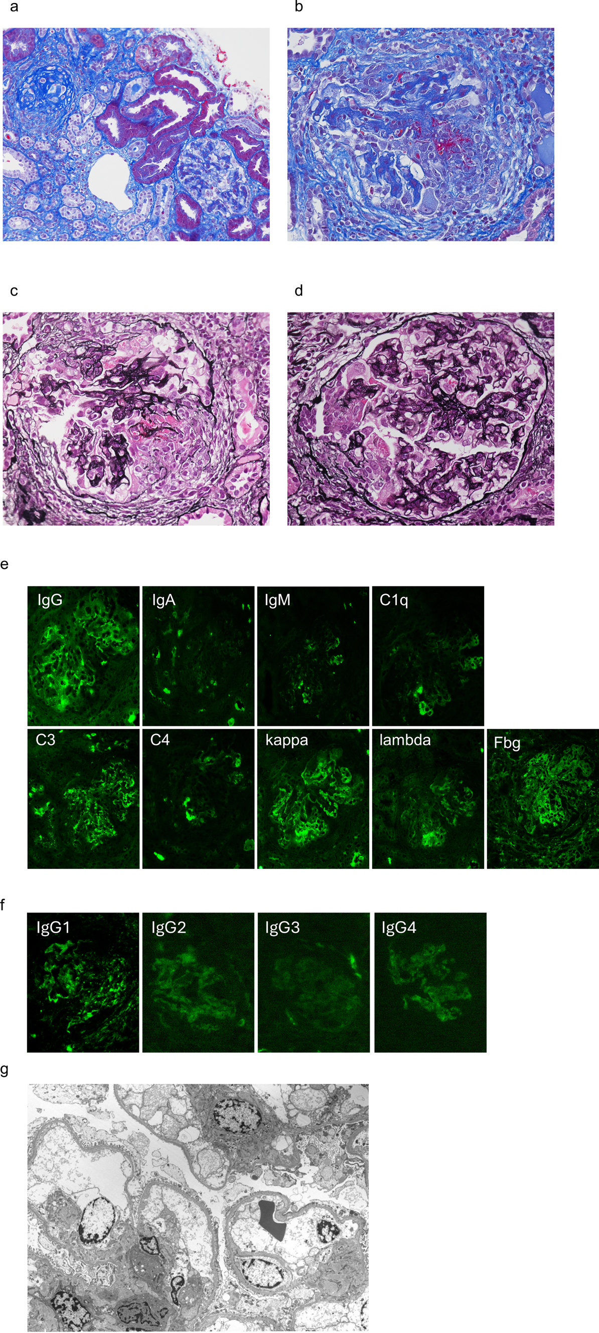 Relapse of subacute anti-glomerular basement membrane nephritis following self-discontinuation of steroid therapy