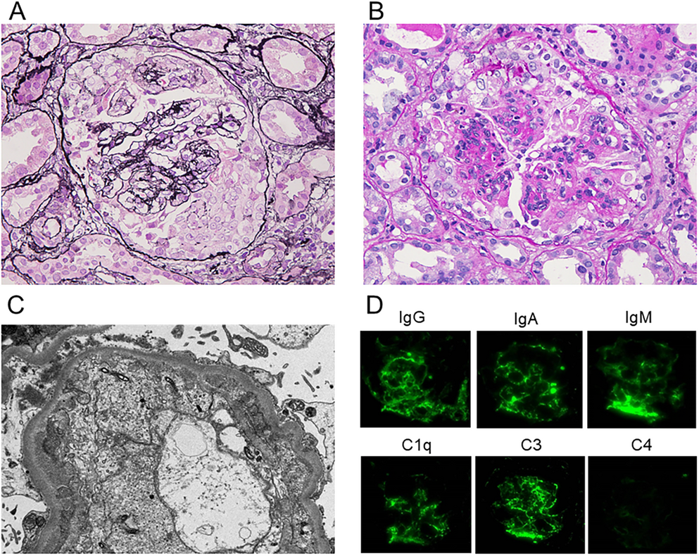 Successful treatment of intractable edema with Goreisan in severe lupus nephritis with nephrotic syndrome: a case report