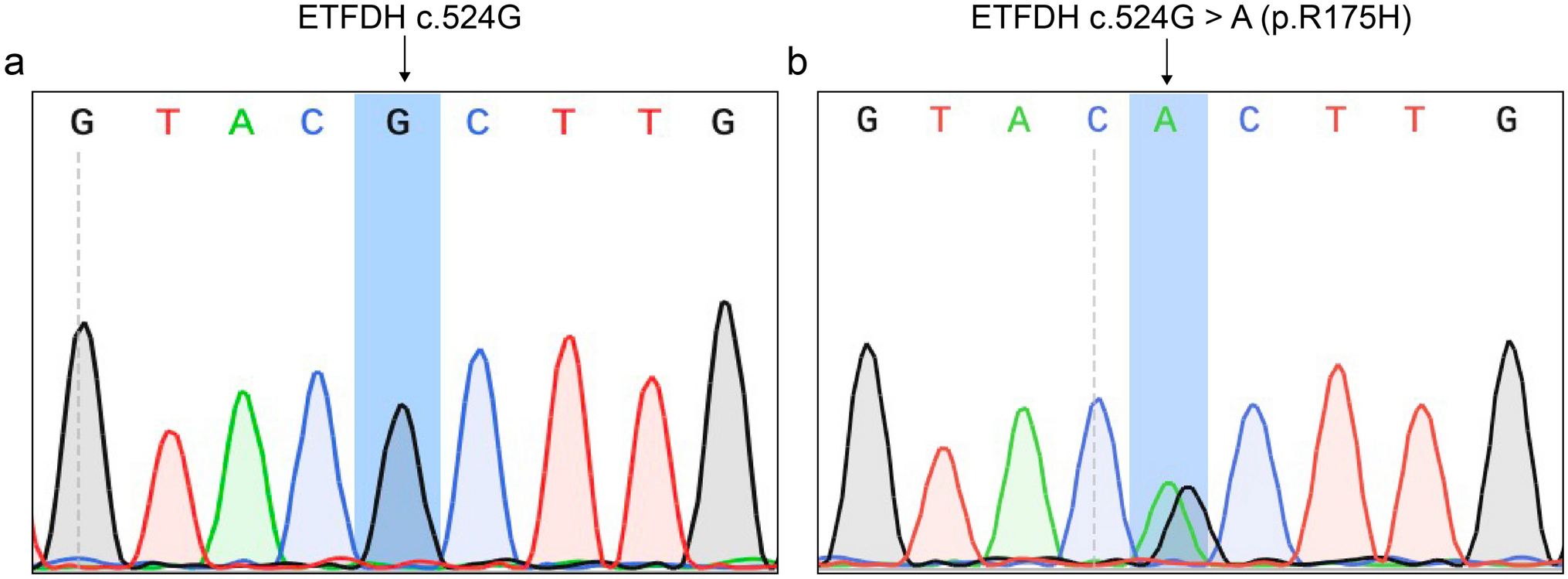 Spinal Cord Involvement in Patients with Adult-Onset Multiple Acyl-CoA Dehydrogenase Deficiency