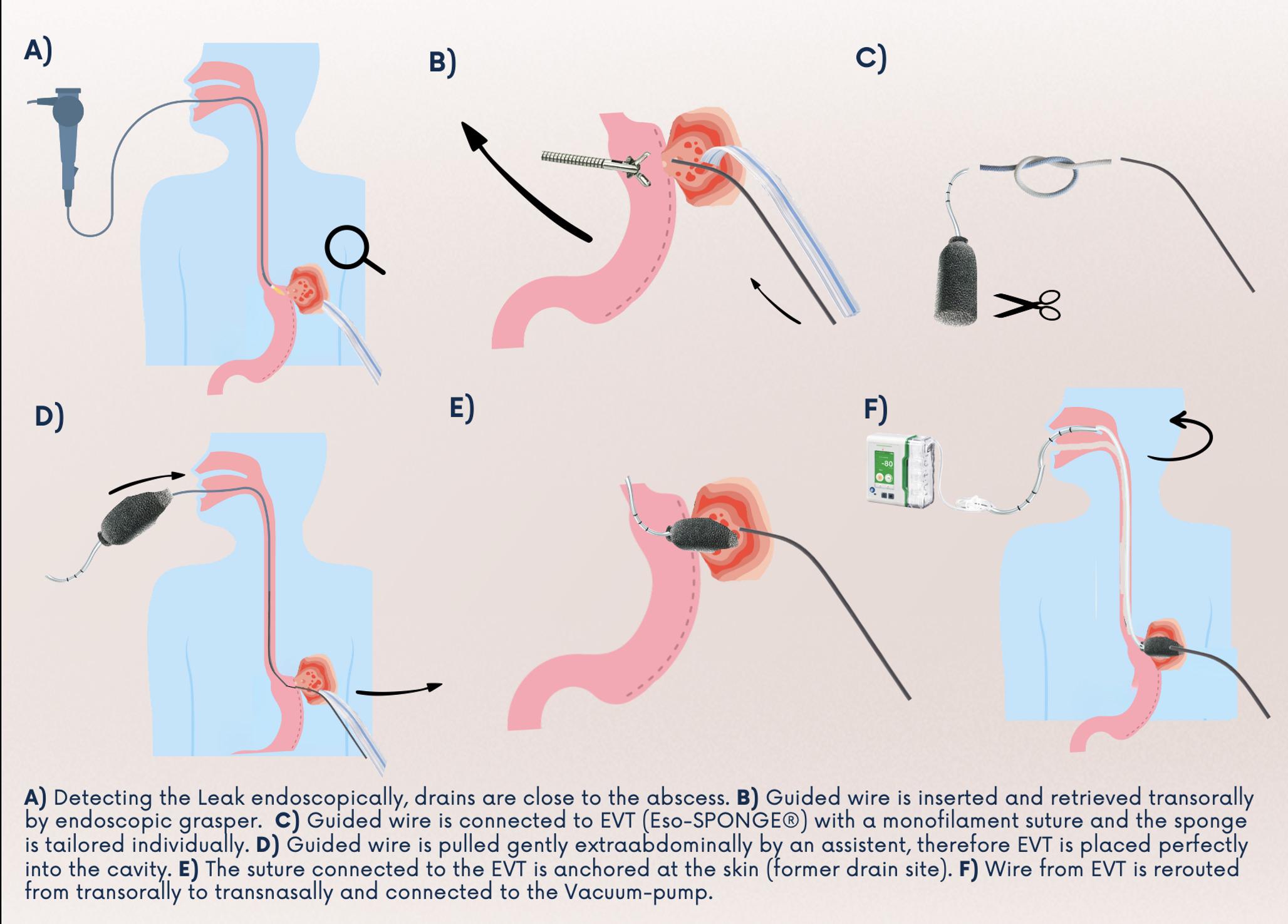 A Case Series and Technical Note on Endoluminal Vacuum Therapy via Pull-Through Technique for Leakage after Metabolic Bariatric Surgery