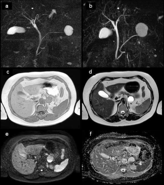 A resected case of pancreatic neuroendocrine neoplasm with completely cystic degeneration mimicking a mucinous cystic neoplasm: a case report and literature review