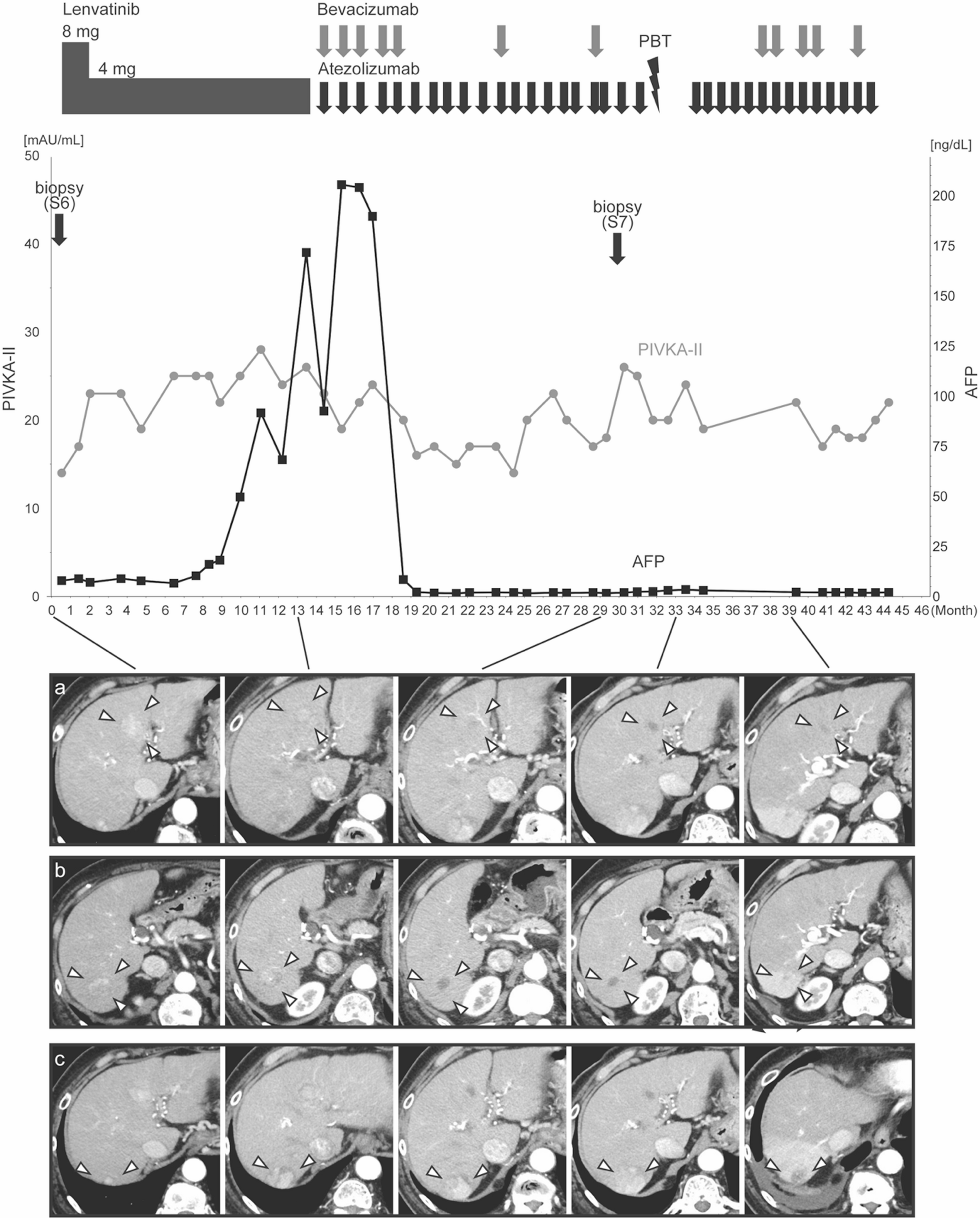 Successful treatment of β-catenin-positive, immune checkpoint inhibitor-resistant tumor in a case of multicentric hepatocellular carcinoma