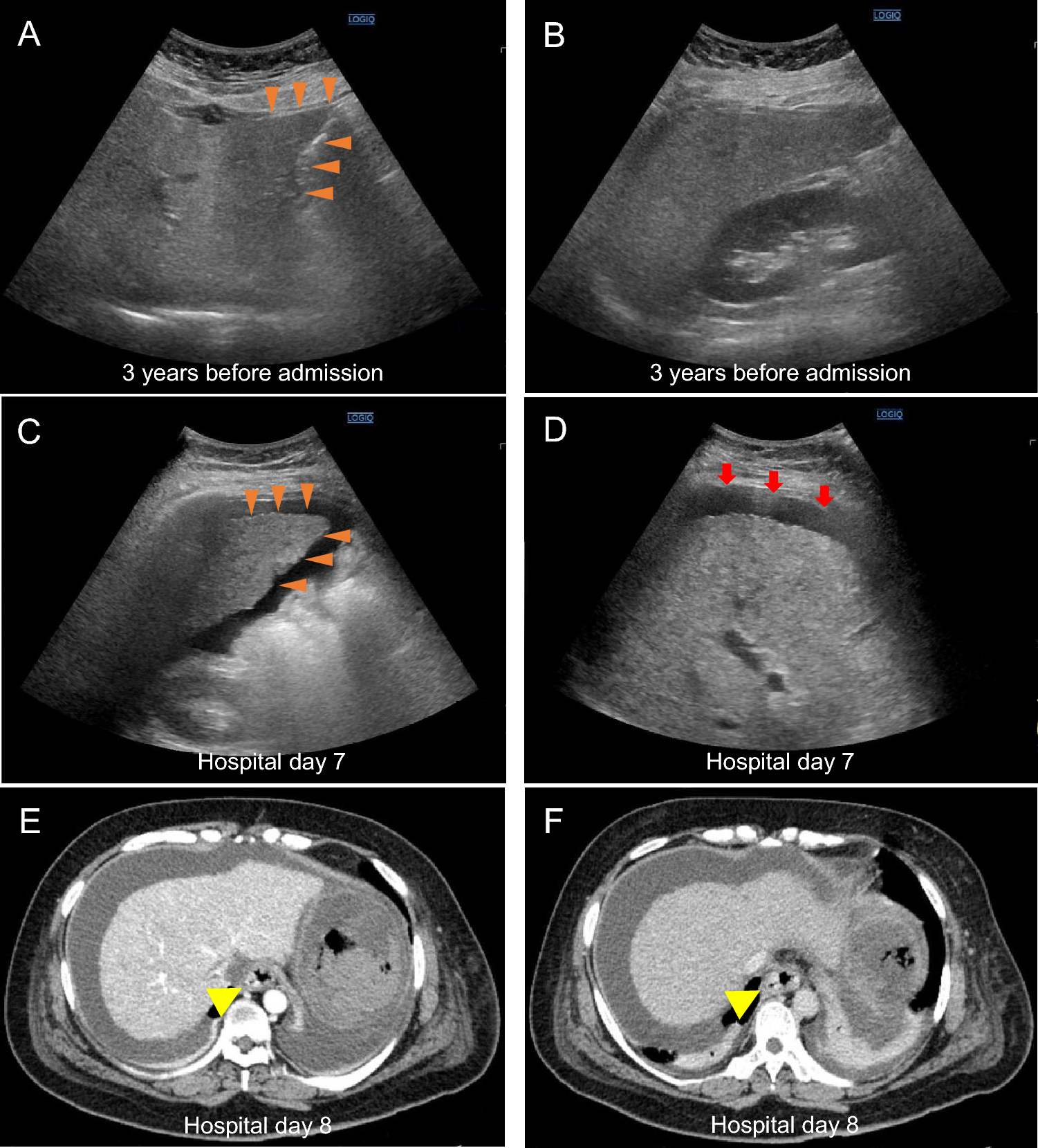Acute-on-chronic liver failure triggered by postpartum variceal bleeding in a patient with alcohol-associated liver disease
