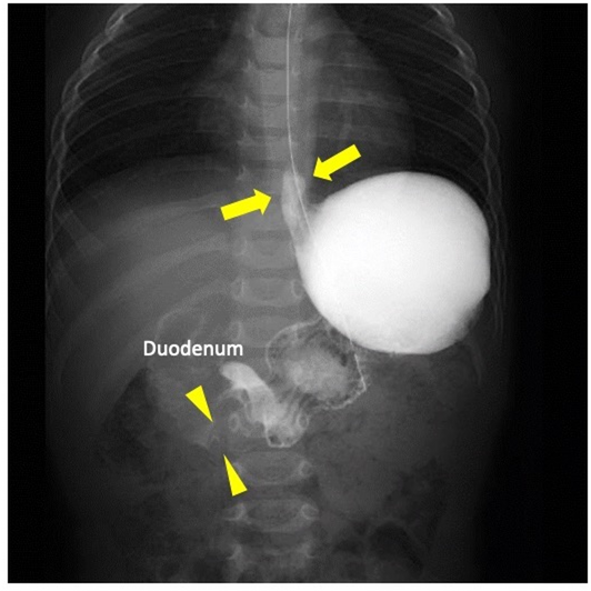 Gastric outlet obstruction secondary to Peutz-Jeghers syndrome successfully managed by polypectomy