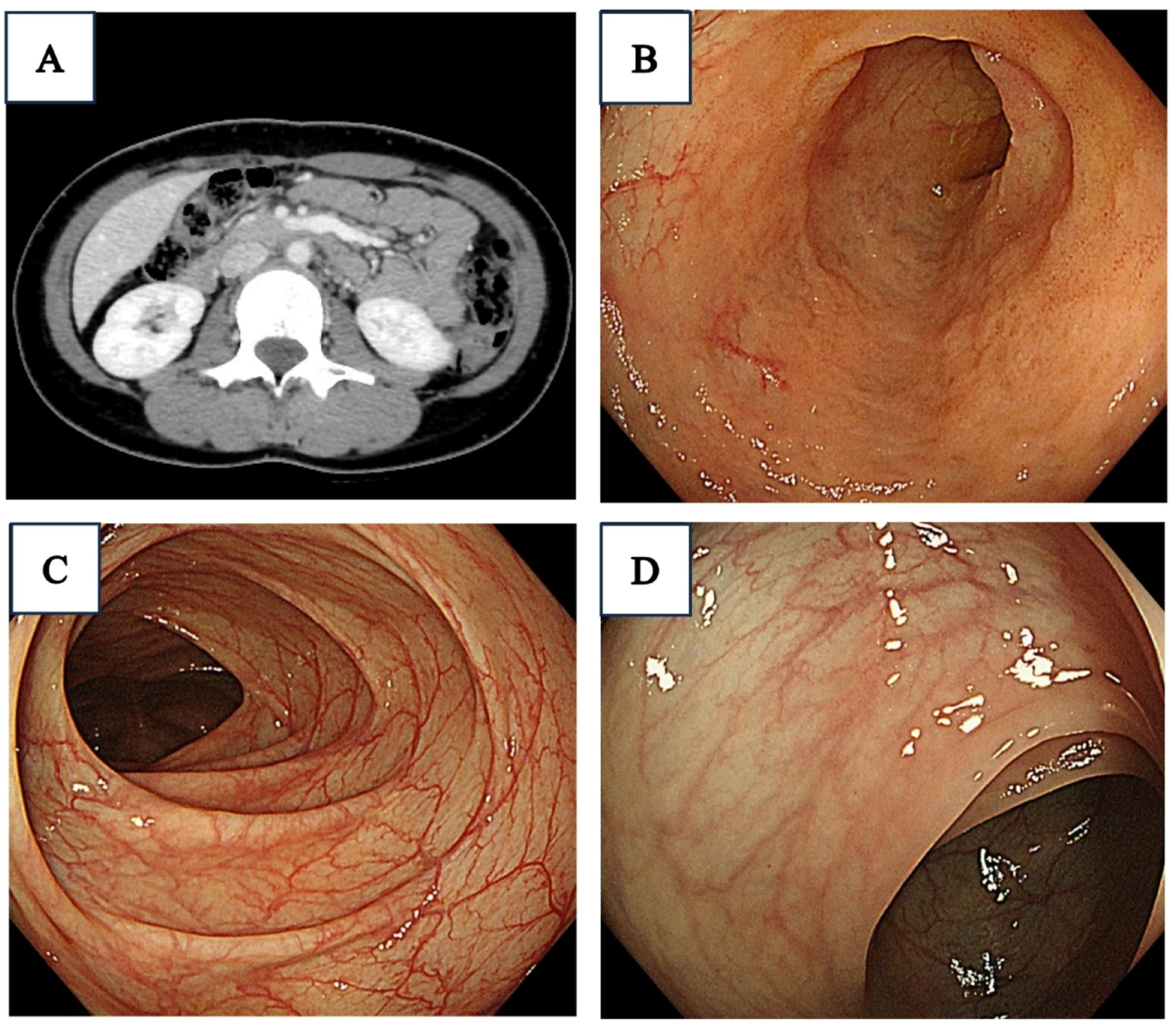A case of cryopyrin-associated periodic syndrome presenting with abdominal symptoms due to a novel mutation  p.Ile257Met